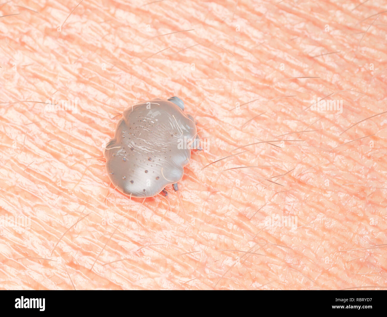 Abbildung einer scabies mite auf die menschliche Haut. Stockfoto