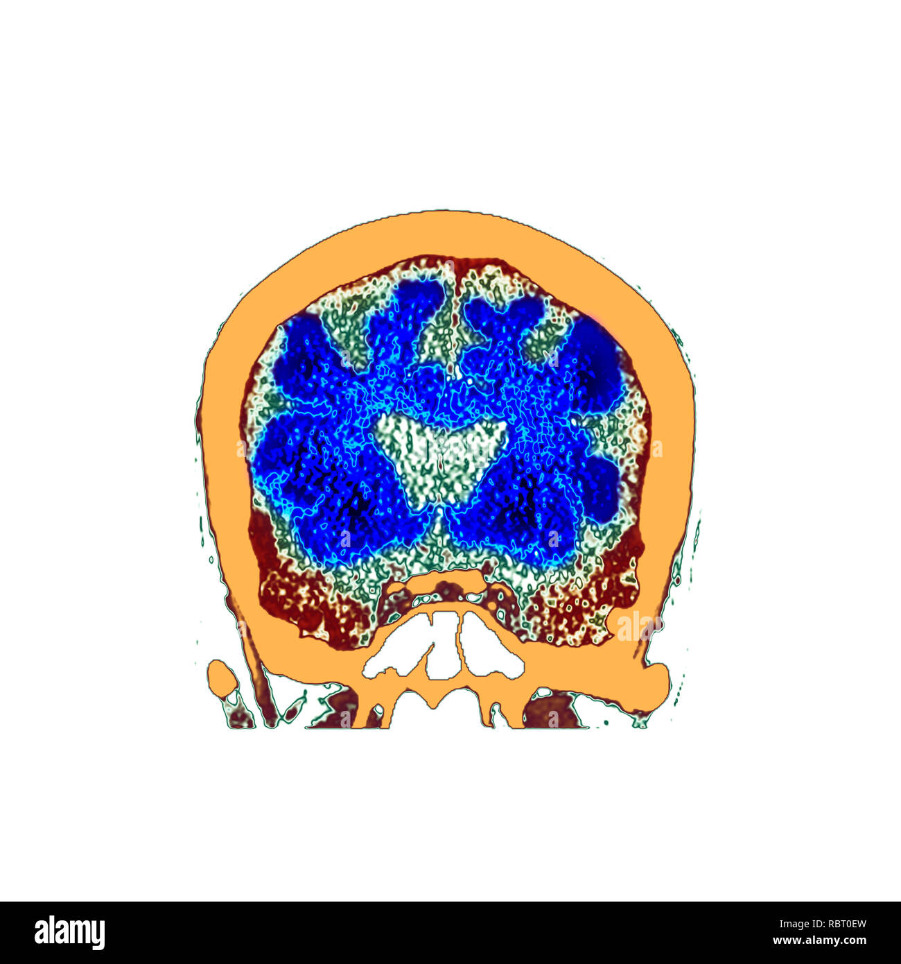 Gehirn Demenz. Farbige Computertomographie (CT) ein Schnitt durch das Gehirn eines 89-jährigen männlichen Patienten mit Demenz zu scannen. Hat das Gehirn verkümmert (verkleinert), die sich durch die Erweiterung der zentralen Herzkammern und tiefe Vertiefungen um die Kanten des Gehirns gezeigt. Stockfoto