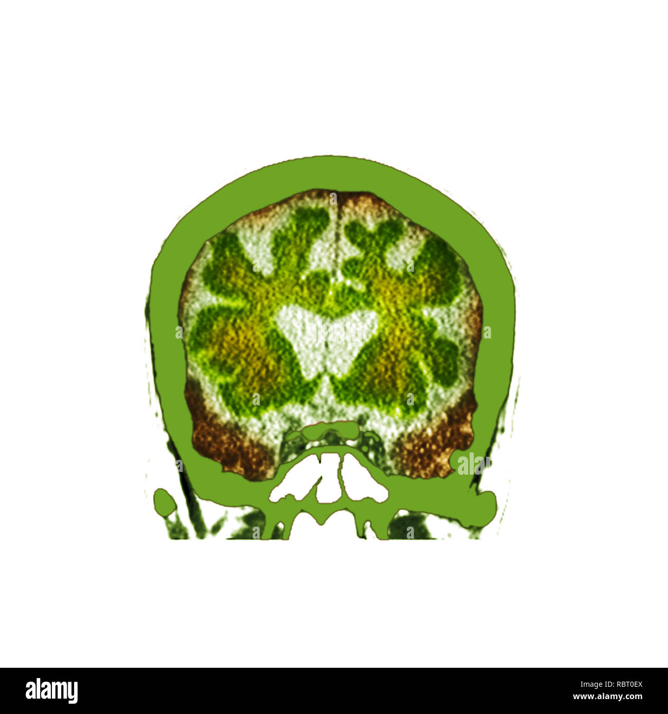 Gehirn Demenz. Farbige Computertomographie (CT) ein Schnitt durch das Gehirn eines 89-jährigen männlichen Patienten mit Demenz zu scannen. Hat das Gehirn verkümmert (verkleinert), die sich durch die Erweiterung der zentralen Herzkammern und tiefe Vertiefungen um die Kanten des Gehirns gezeigt. Stockfoto