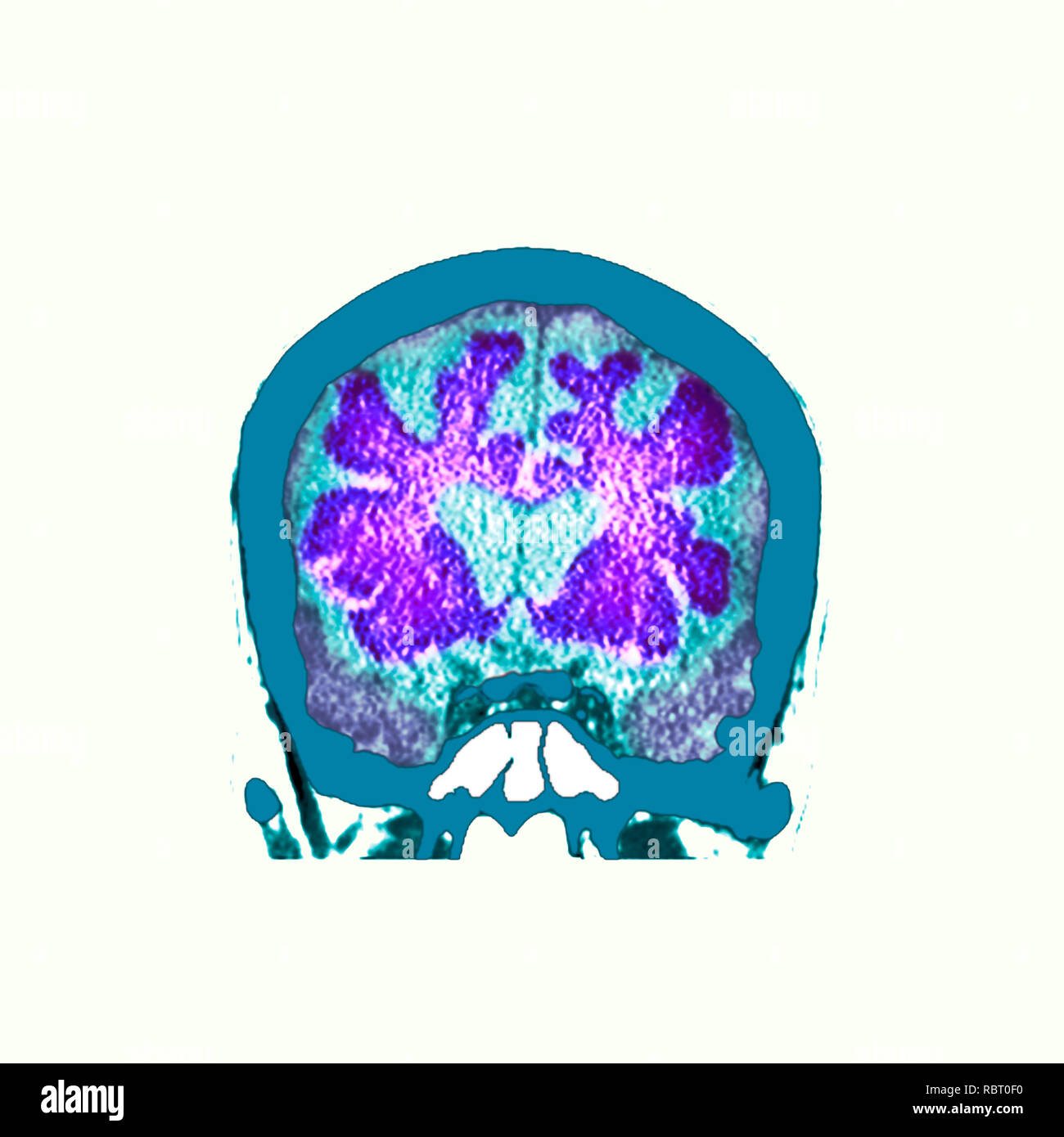 Gehirn Demenz. Farbige Computertomographie (CT) ein Schnitt durch das Gehirn eines 89-jährigen männlichen Patienten mit Demenz zu scannen. Hat das Gehirn verkümmert (verkleinert), die sich durch die Erweiterung der zentralen Herzkammern und tiefe Vertiefungen um die Kanten des Gehirns gezeigt. Stockfoto