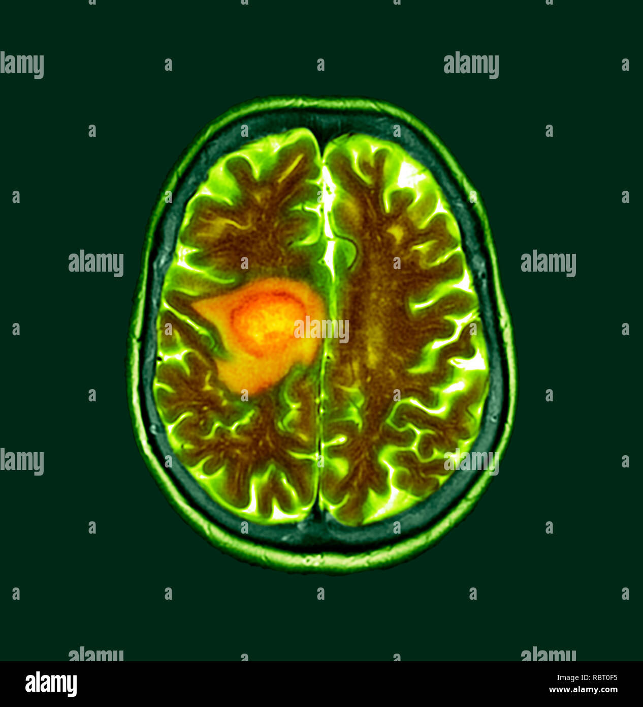 Glioblastom Gehirn Krebs. Farbige Computertomographie (CT) ein Schnitt durch das Gehirn eines 84-jährigen Patientin mit Glioblastom (dunklen Scans, links). Glioblastom, der aggressivsten Form des Hirntumors. Behandlung bezieht, Chirurgie, Chemotherapie und Strahlentherapie verwendet werden. Aber der Krebs in der Regel erneut auftritt, die trotz Behandlung und die häufigsten Dauer der Überlebenszeit nach der Diagnose ist 12-15 Monate. Ohne Behandlung, Überleben ist in der Regel 3 Monate. Stockfoto