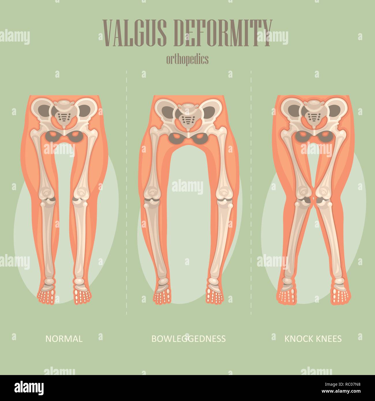 Hallux Valgus Illustration Stockfotos und bilder Kaufen Alamy