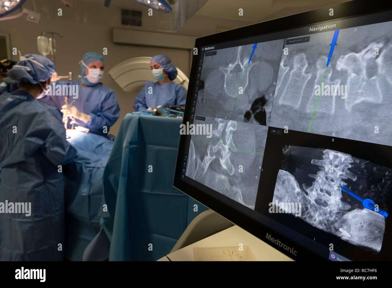 Ärzte, die Wirbelsäulenchirurgie mit neuronavigation computer-unterstützte Technologie system Stockfoto