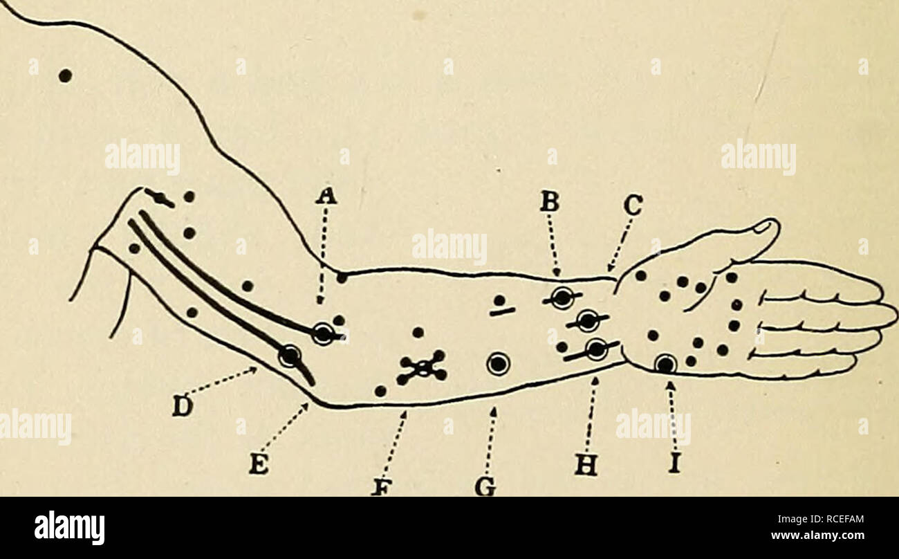 . Richtungen für die Arbeit im Labor in der Physiologie. Physiologie. 66 EXPERniENT XIII. Die platinum Elektroden auf die Beiträge des zweiten - arv Spule anschließen. Die Enden der Elektroden auf dem angefeuchteten Papier legen und die primären Stromkreis bilden, dann die Elektroden Kig schieben. 14. Apparate und Richtung der Stromfluss in der sekundären Spule von einer Induktion Apparate zu erkennen. Ein, chemische Zelle; B, Quecksilber Schlüssel; C, primären Spule; U, sekundäre Spule; E, Elektrode. lo eine frische und brechen. Ein dunkler Punkt auf dem einen Pol, und auf der anderen auf Br. Eaking gegeben werden, es wird jedoch keine Wirkung wird während der Zeit, in der die Pri gesehen werden. Stockfoto