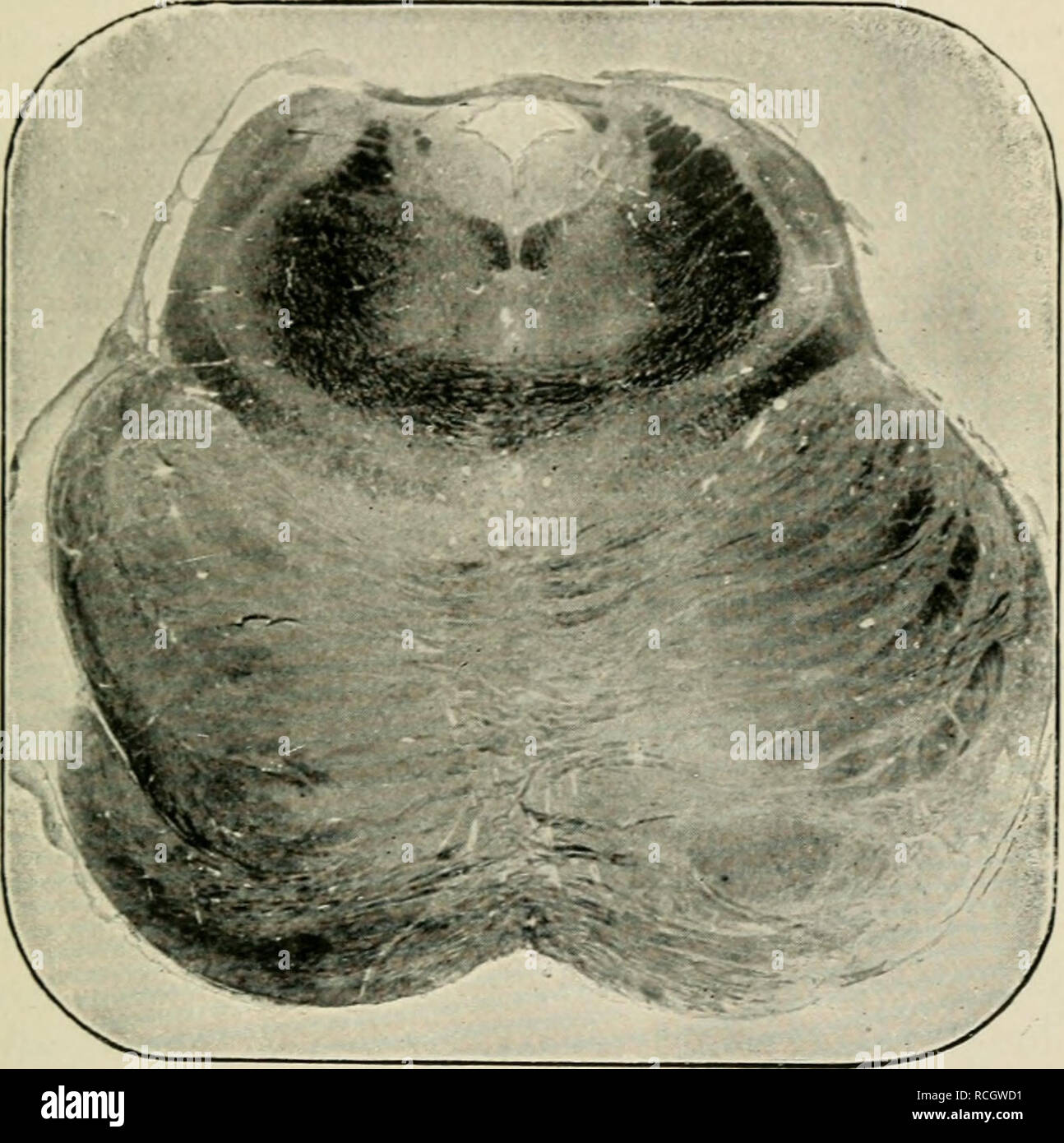 . Elemente der Histologie. Die Histologie. Medulla Oblonga ta. 227 Teil liegen auf der ventralen Seite vielleicht gesehen, Massen von Zellen foi-mini: der Beginn der Kerne von S.C.P IV. I. in der IV. V. S.C.P. P.L.B. L.F M.F Abb. 147. - Abschnitt throus. c. p.", die unteren Enden treffen in der mittleren Zeile, sind die Superior cerebellar Stiel oder lirachia Bindehaut. Die Fläche, die zwischen Ihren unteren Hälften formen Fsme teirmentum. Tbe iiuadrangular Raum lielow i ist der Sylvian aiiueduct. Decussating in das Ventil des Vieussens oben sind Fasern des iv. Nerv, die zwei kleinen dunklen Massen unter iv, die die Tr gesehen Stockfoto