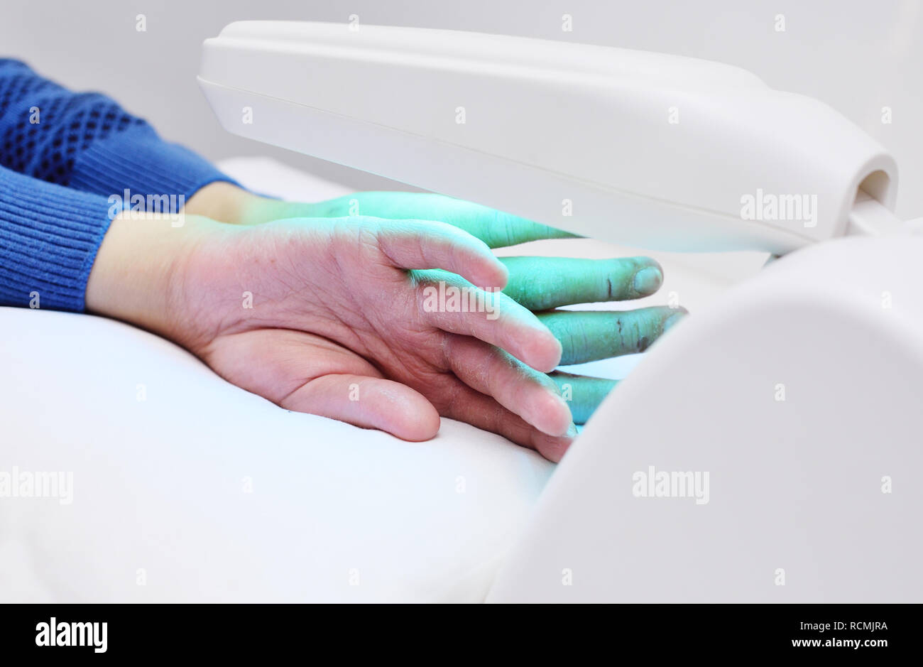 Die Hände eines Patienten mit Psoriasis close-up unter einer UV-Lampe. Stockfoto