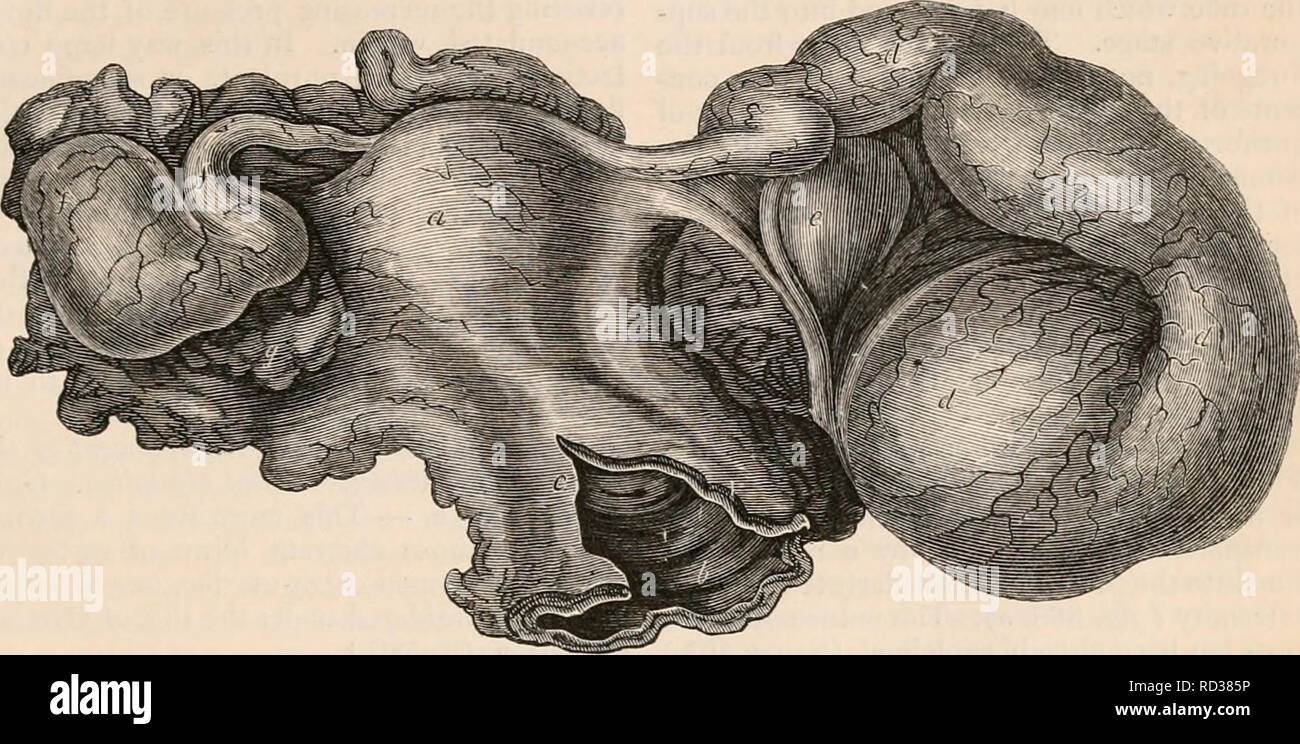 . Die cyclopaedia von Anatomie und Physiologie. Anatomie, Physiologie, Zoologie. Eileiter OH EILEITER - (abnormalen Anatomie). curring in die akute oder chronische Form, die Flüssigkeit abgesondert wird mehr tun kann, als in einem Zustand der Gesundheit, kann von einem oder beiden der tubal Öffnungen vent, so lange diese re-Main durchlässig. Es ist wahrscheinlich, dass in dieser Zuneigung die überreiche Flüssigkeit fließt in der Regel durch die untere Öffnung in die Gebärmutter, und so entgeht per vaginam, die zusammen einer Der zahlrei-Formen von "leucorrhcea." Aber, wenn beide Ex-tremities des Rohrs geschlossen sind, dann, wie im Fall o Stockfoto