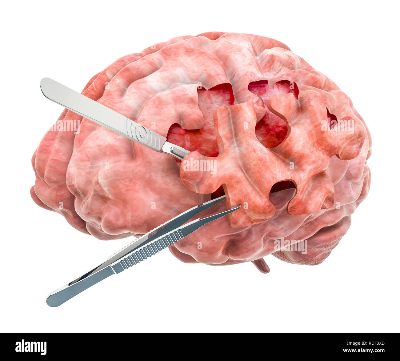 Gehirnchirurgie Konzept. 3D-Rendering auf weißem Hintergrund Stockfoto