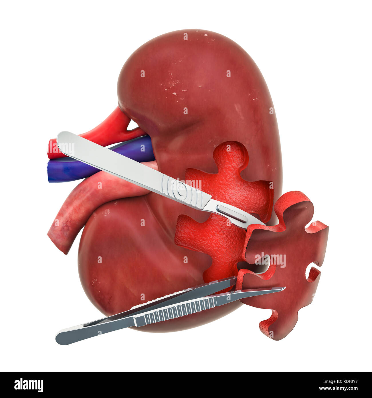 Niere Chirurgie Konzept, 3D-Rendering auf weißem Hintergrund Stockfoto