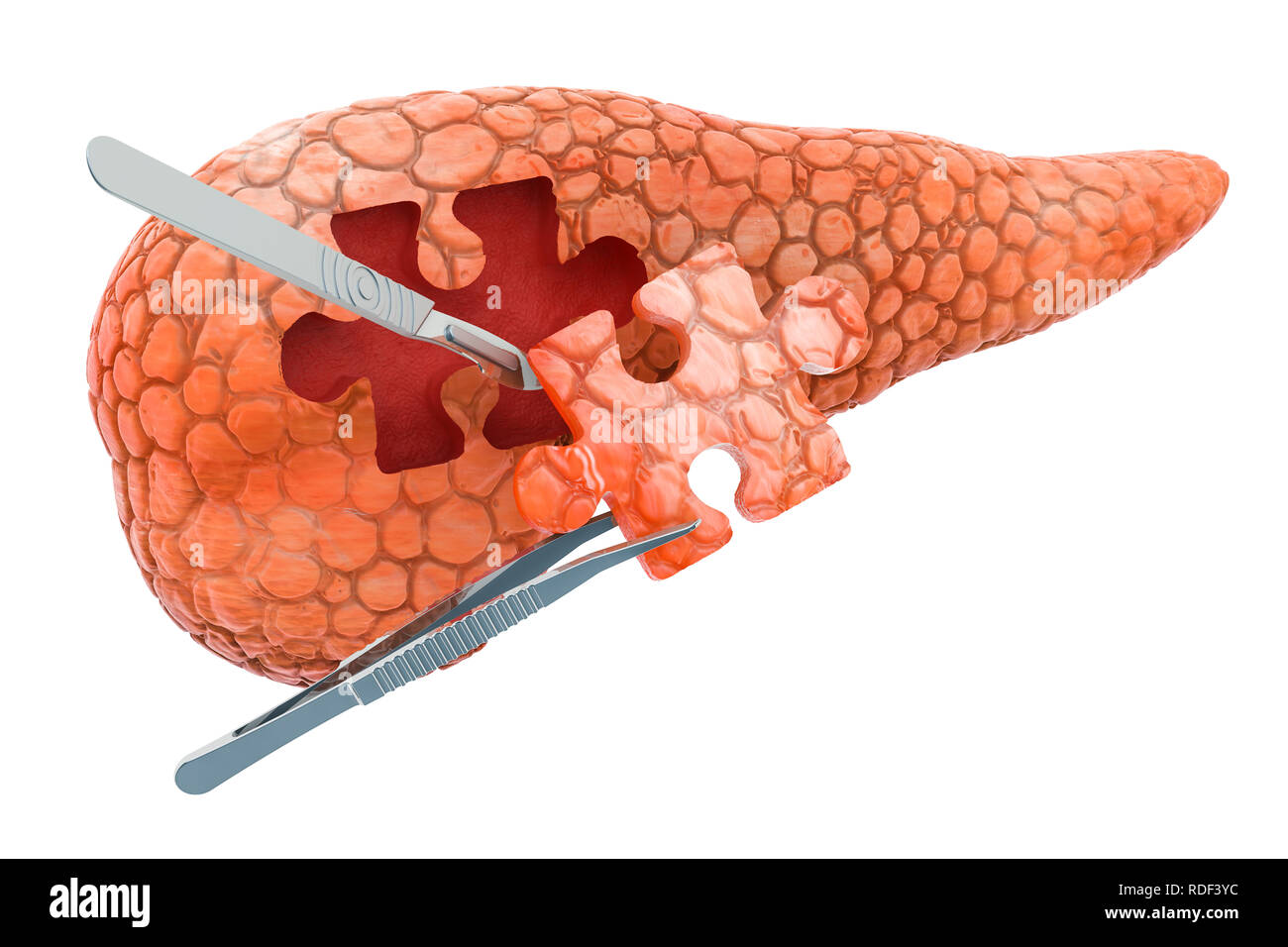 Bauchspeicheldrüse Chirurgie Konzept, 3D-Rendering auf weißem Hintergrund Stockfoto