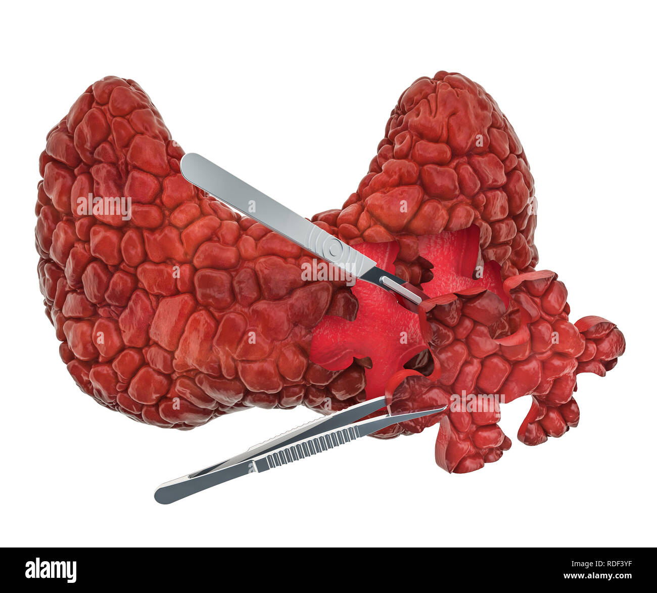 Schilddrüsechirurgie Konzept, 3D-Rendering auf weißem Hintergrund Stockfoto