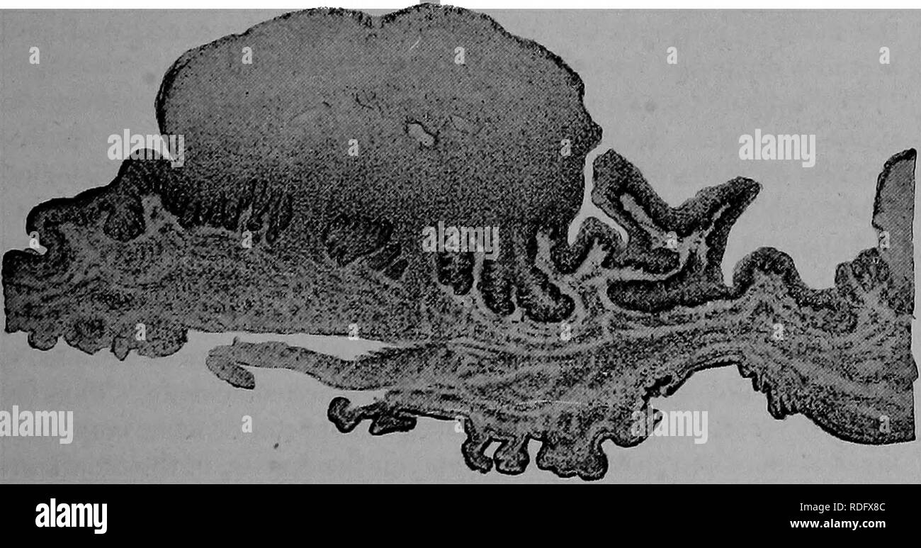 . Die Pathologie und differenzierte Diagnose von Infektionskrankheiten der Tiere: für Studierende und Praktiker der Veterinärmedizin vorbereitet. Veterinärmedizin; übertragbaren Krankheiten bei Tieren. :^3i ^j^ iiaiisa Abb. 112. baklt Stadien der diphtheritic Nekrose im Hals op eine Taube. Kult. Die Schleimhäute von Mund und Rachen sind Con-Gested und Zahlreiche dunkelrote Erhebungen bedeckt mit Fibrinöse Exsudat zeigen. Die patches auf der Zunge an Größe zugenommen haben, sind Sie in der Farbe grau, an den Rändern der Zunge getrocknet, aber weich und auf der Oberseite abgeflacht. Sie sind abgedeckt Stockfoto