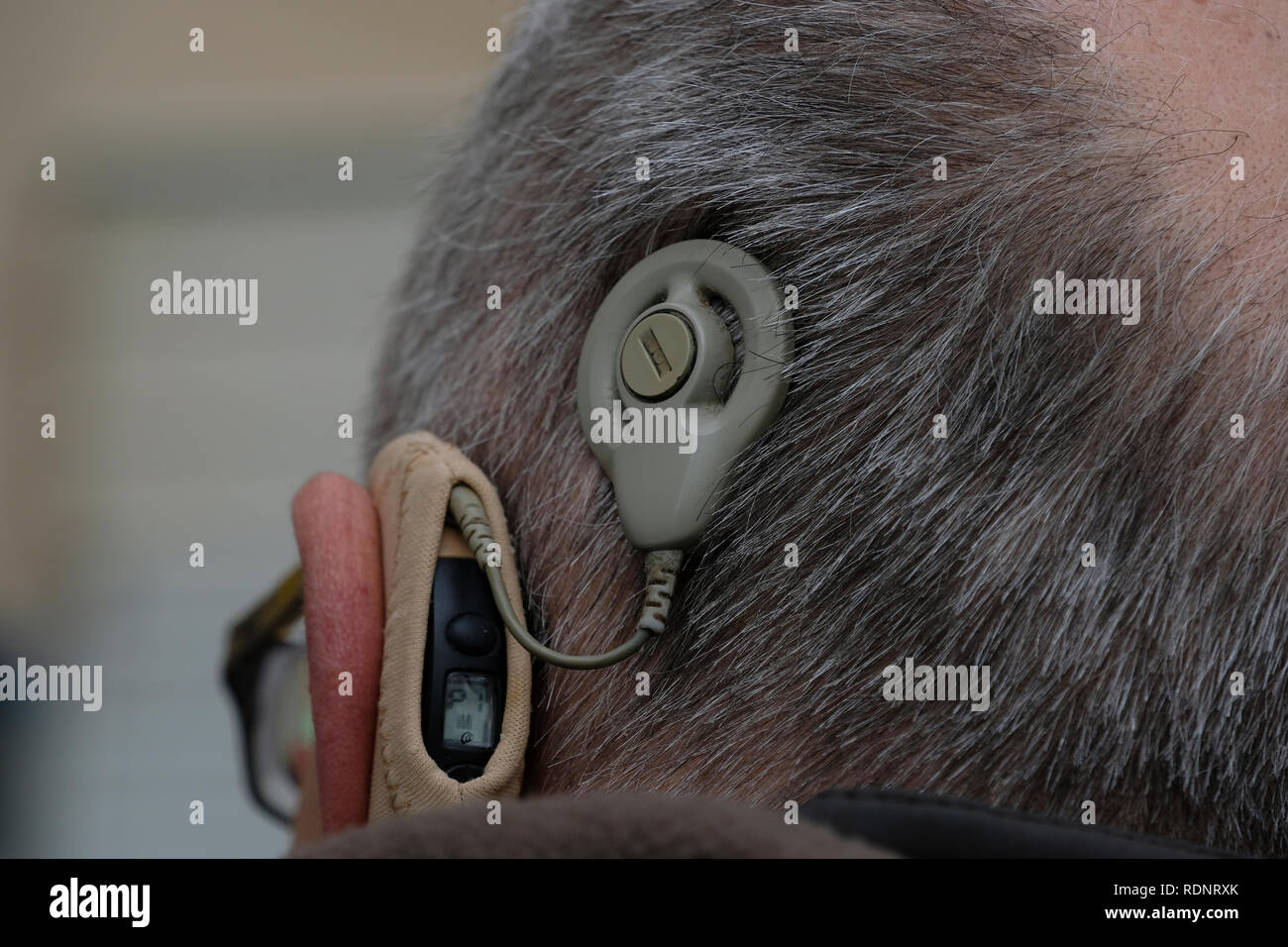 Ein erwachsener Mensch leiden mit schweren, bleibende Hörschäden und ein Problem mit dem Hörnerv mit einem Auditory Brainstem Implant (ABI) Gerät. Stockfoto