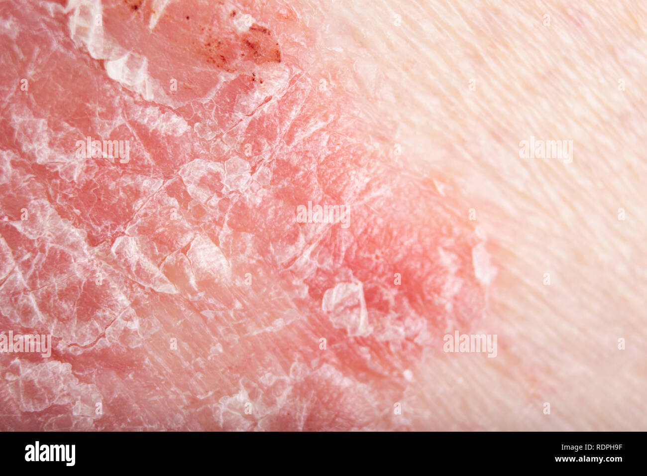 Roter Erhabener Fleck Auf Der Haut www.alamy.de