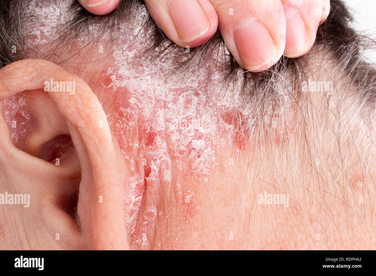 Psoriasis im ohr Fotos und Bildmaterial in hoher Auflösung Alamy