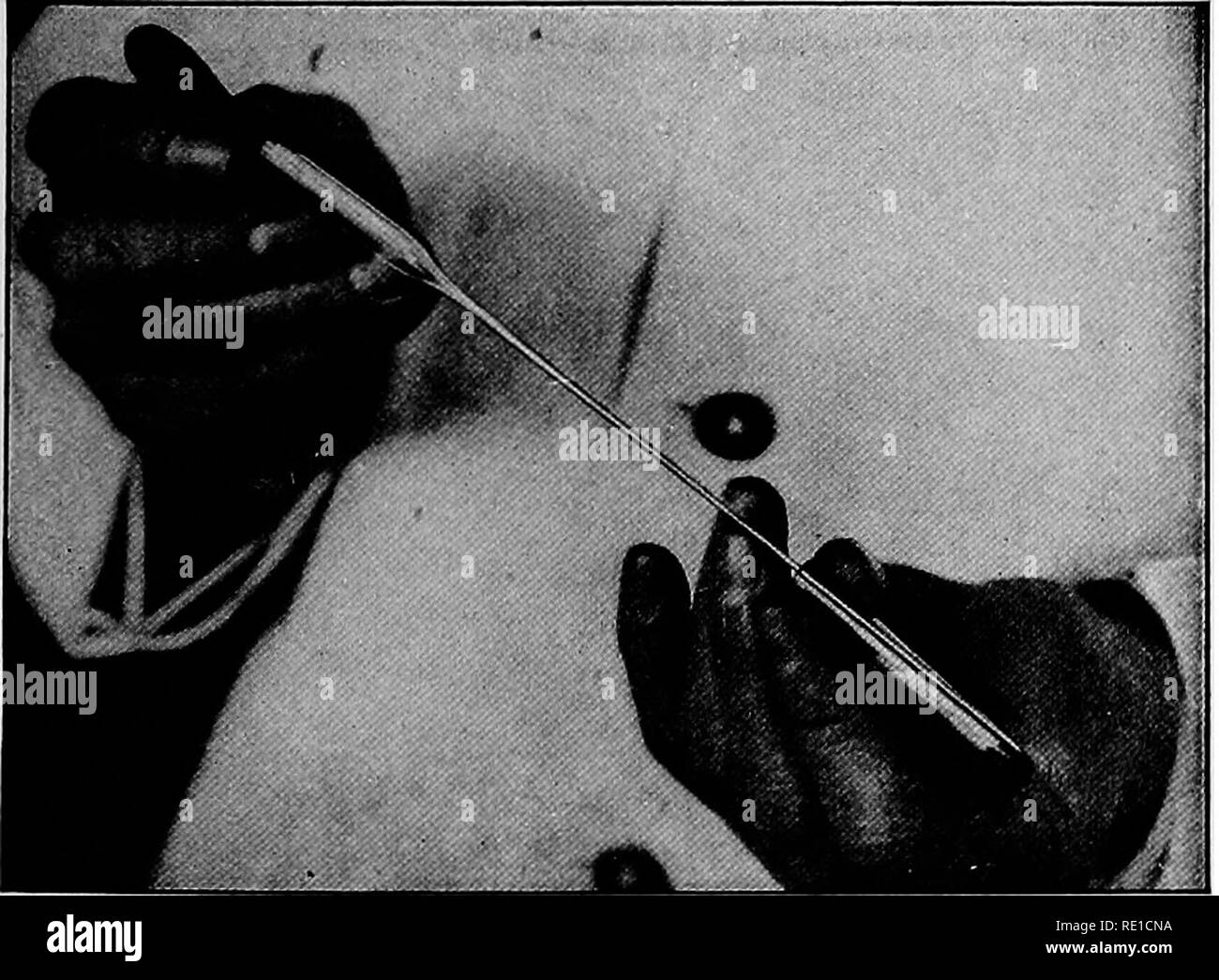 . Ein text-Buch auf die pathogenen Bakterien und Protozoen für Studenten der Medizin und Ärzte. Bakteriologie; pathogenen Bakterien und Protozoen. P'ig. 92.-Schlauch des Bluts und Citrat- Lösung vor und nach centrifugalizing (Miller). Abb. 93.-Entfernen letzte Tropfen Kochsalzlösung (Miller). Das Serum geprüft zu werden und die noimal Serum für den Vergleich sind in der gleichen Weise befestigt, der ehemalige vom Patienten, die vom Bediener. So ist es ratsam, die Patienten zu Wunde aber einmal, das Rohr für den Erhalt der Serum sollte gleichzeitig gefüllt werden, dass die citrated Blut genommen wird.. Bitte Stockfoto