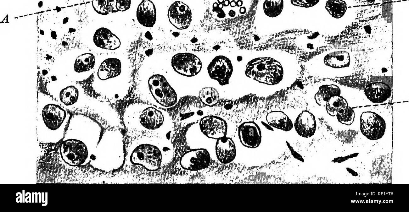 . Ein text-Buch auf die pathogenen Bakterien und Protozoen für Studenten der Medizin und Ärzte. Bakteriologie; pathogenen Bakterien und Protozoen. -. - JbK". Abb. 265.- Entamoeba histolytica. Abschnitt des menschlichen intestinalen Wand zeigt die Amebas an der Unterseite eines dysenteric Geschwür: A, A, A, Amebas, von denen einige im Blut - Schiffe, Gf (Harris). zerstört, so dass der gesamte Dickdarm kahle, außer für gelegentliche Inseln viel überlasteten, entflammt, und teilweise nekrotischen Schleimhaut. Die erkrankten Darmwand ist der Sitz von viel Staus und ist viel dicker. Die Amebas nicht nur Trade Boxes Stockfoto