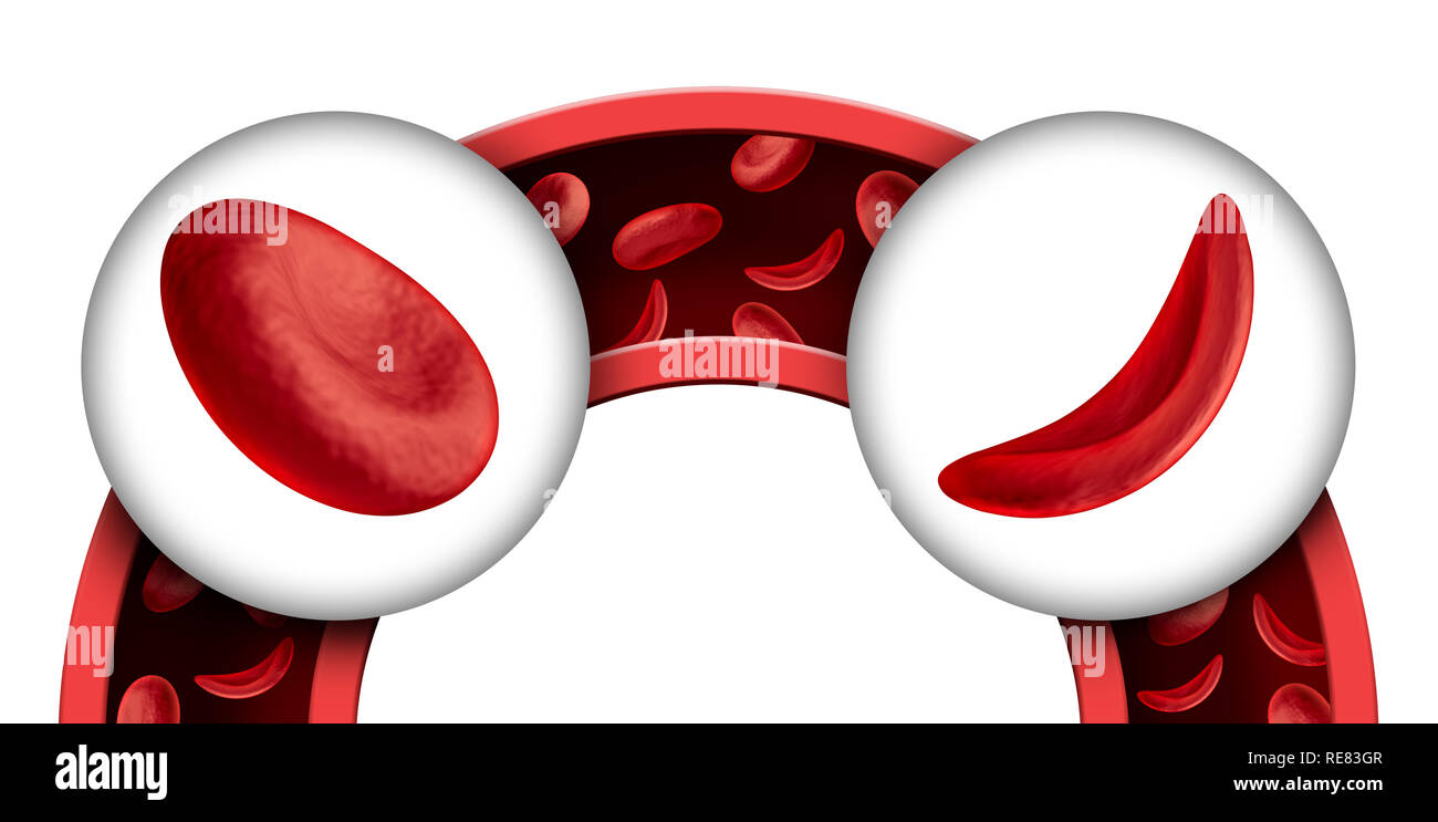 Sichelzellenanämie als rotes Blut Krankheit als normale und abnormale Hämoglobin Anatomie medizinische Illustration Konzept in einer 3D-Render. Stockfoto