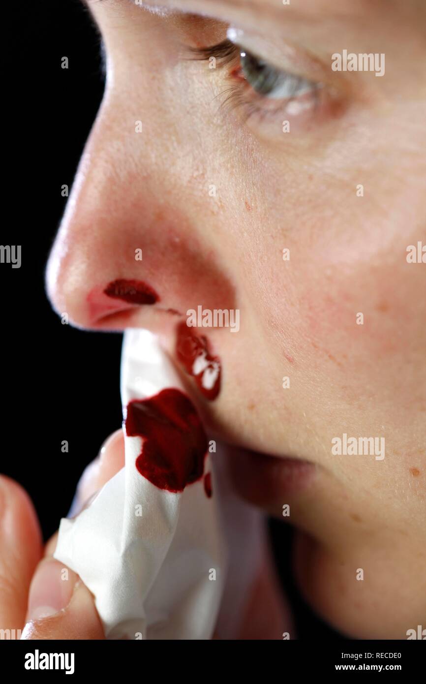 Nase einer jungen Frau Blutungen Stockfoto
