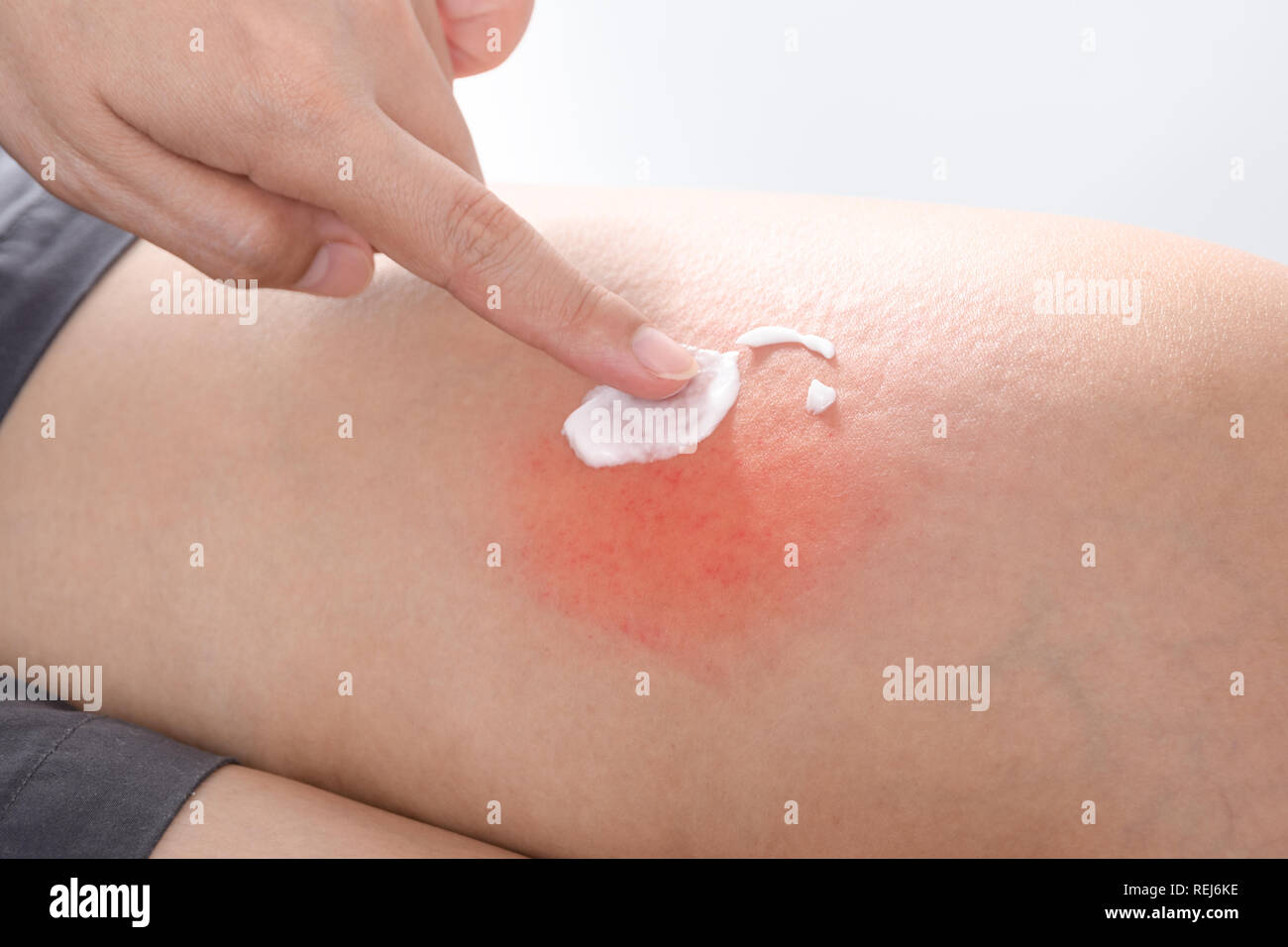 Scratch allergische Haut von Mücke oder Insektenstichen und Medizin eincremen, Gesundheitswesen und Medizin concpet Stockfoto