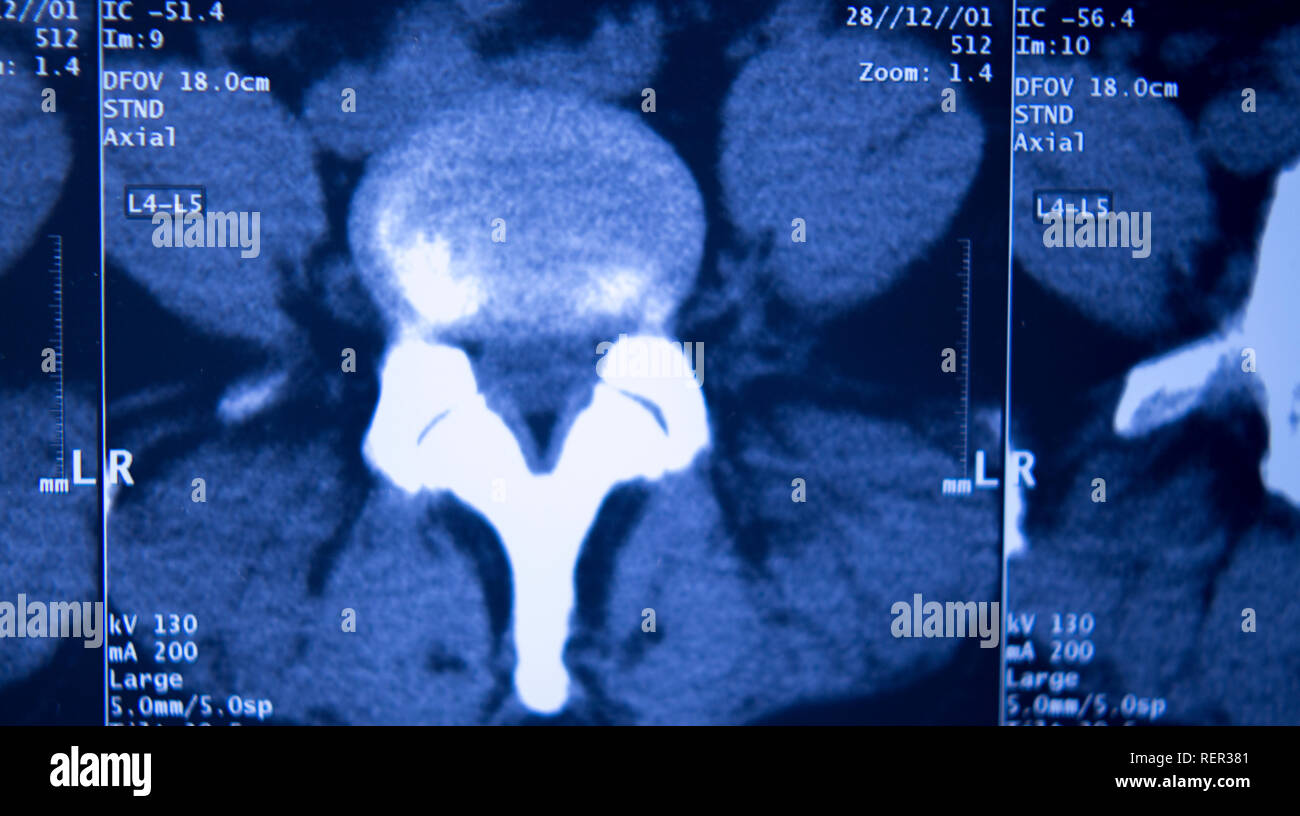 Medizinische Klinik x-ray Hüfte Wirbelsäule Becken MRI Traumatologie scannen. Stockfoto
