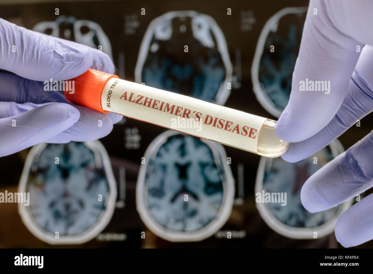 Wissenschaftler hält Blutprobe Abhilfe gegen die Alzheimer Krankheit zu untersuchen, konzeptionelle Bild Stockfoto
