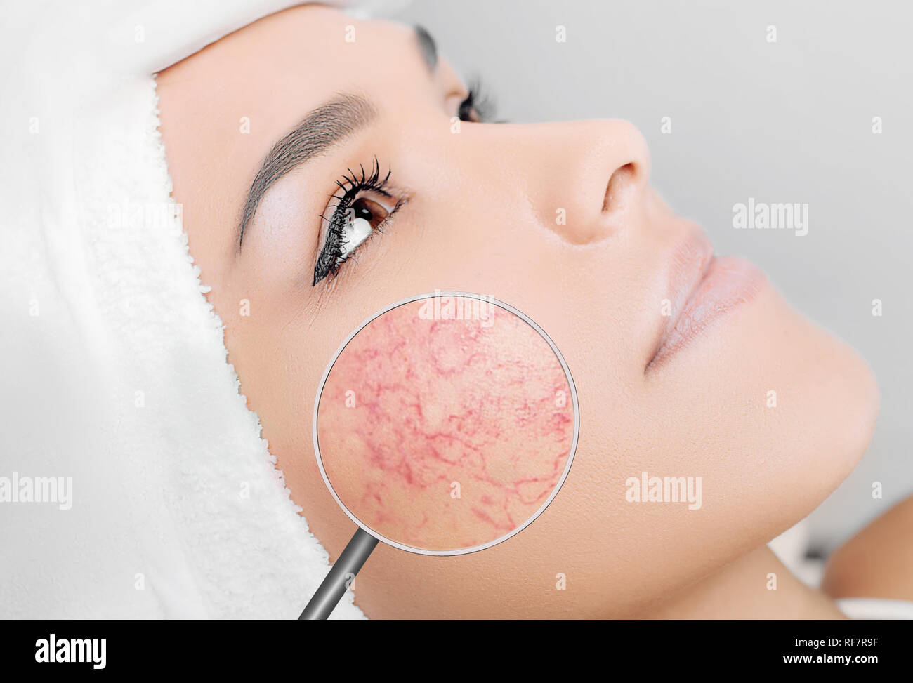 Lupe angezeigt Couperose auf womans Gesicht Stockfoto