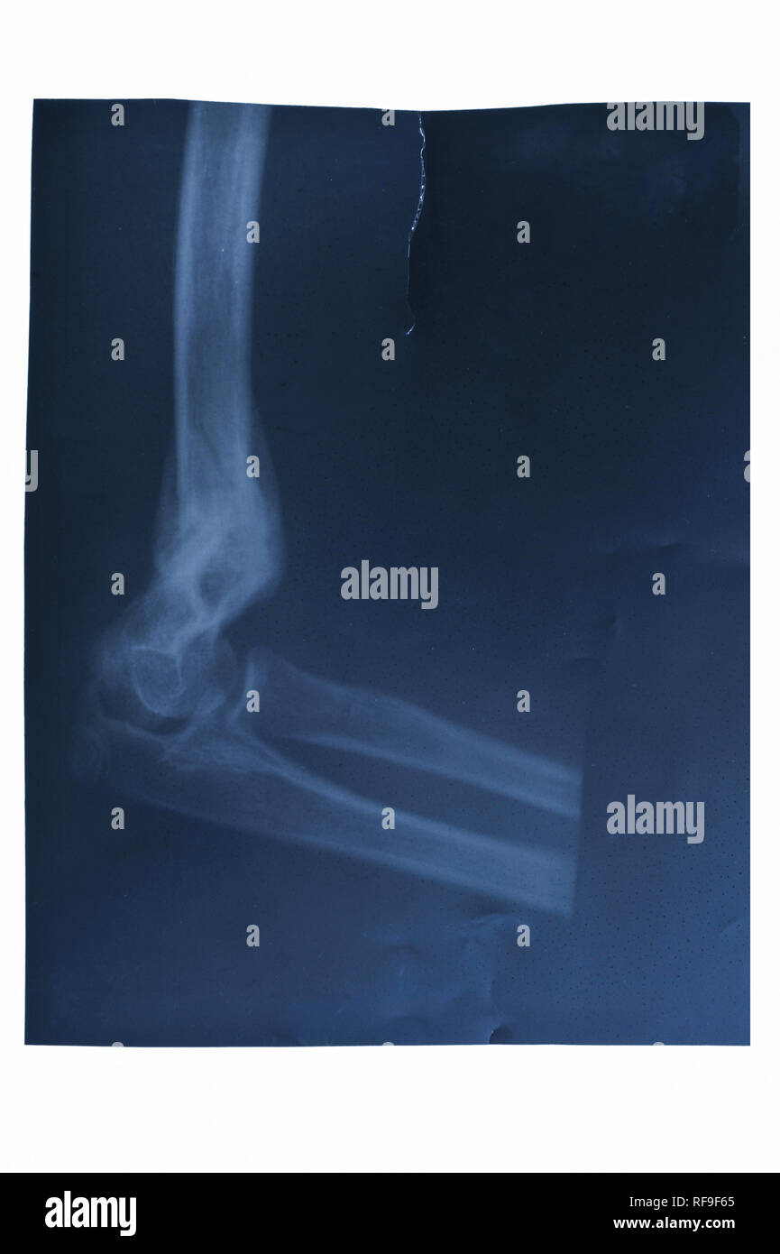 X-ray von unterarm auf weißem Hintergrund Stockfoto