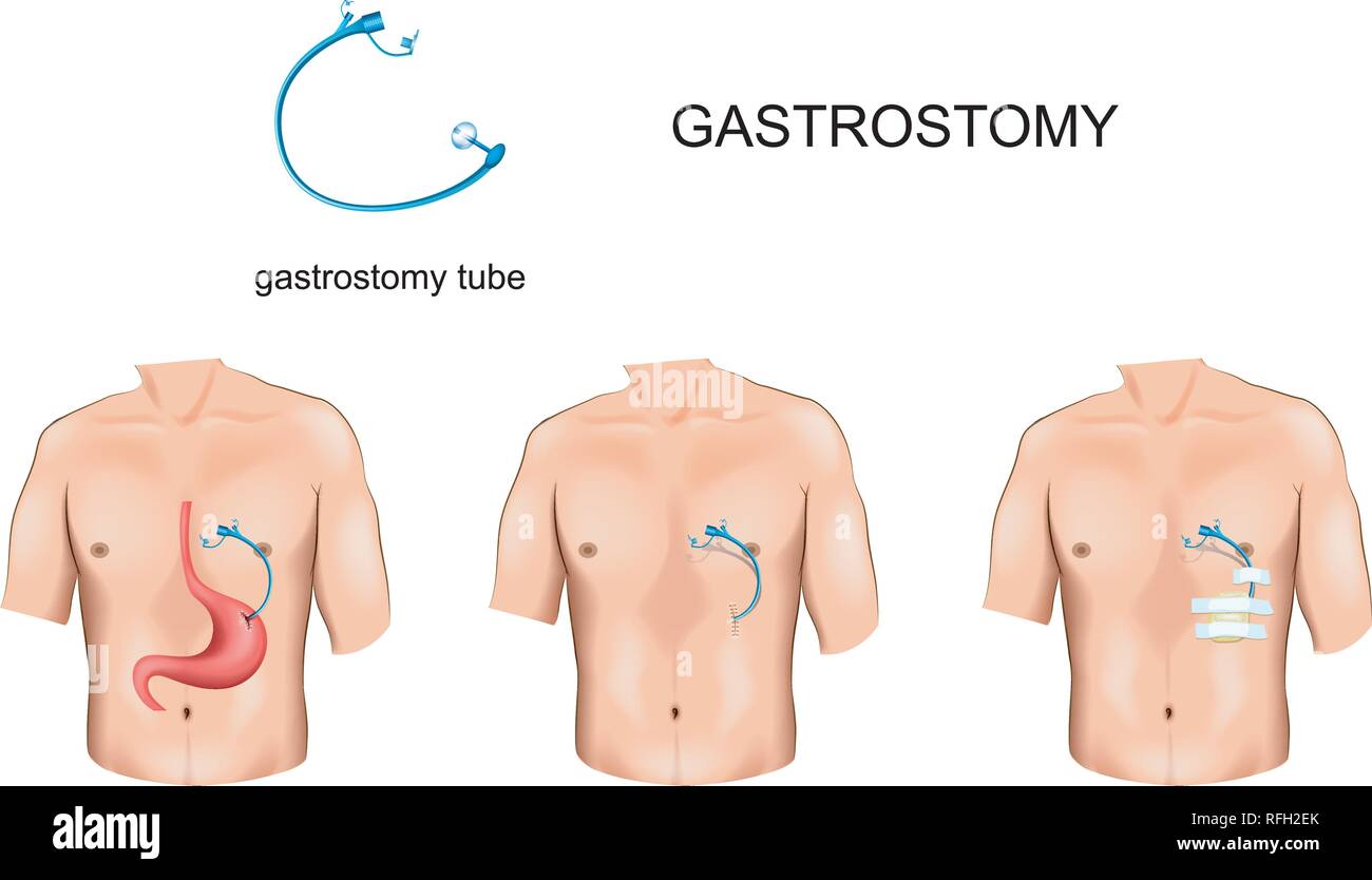 Vector Illustration von gastrostomie Rohr mit speiseröhre Verstopfung Stock Vektor