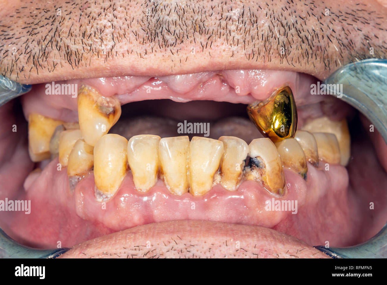 Schlechte Zähne des Patienten beim Zahnarzt Zahnarzt Nahaufnahme Makro. Karies, Zahnbelag schadet Rauchen Stockfoto