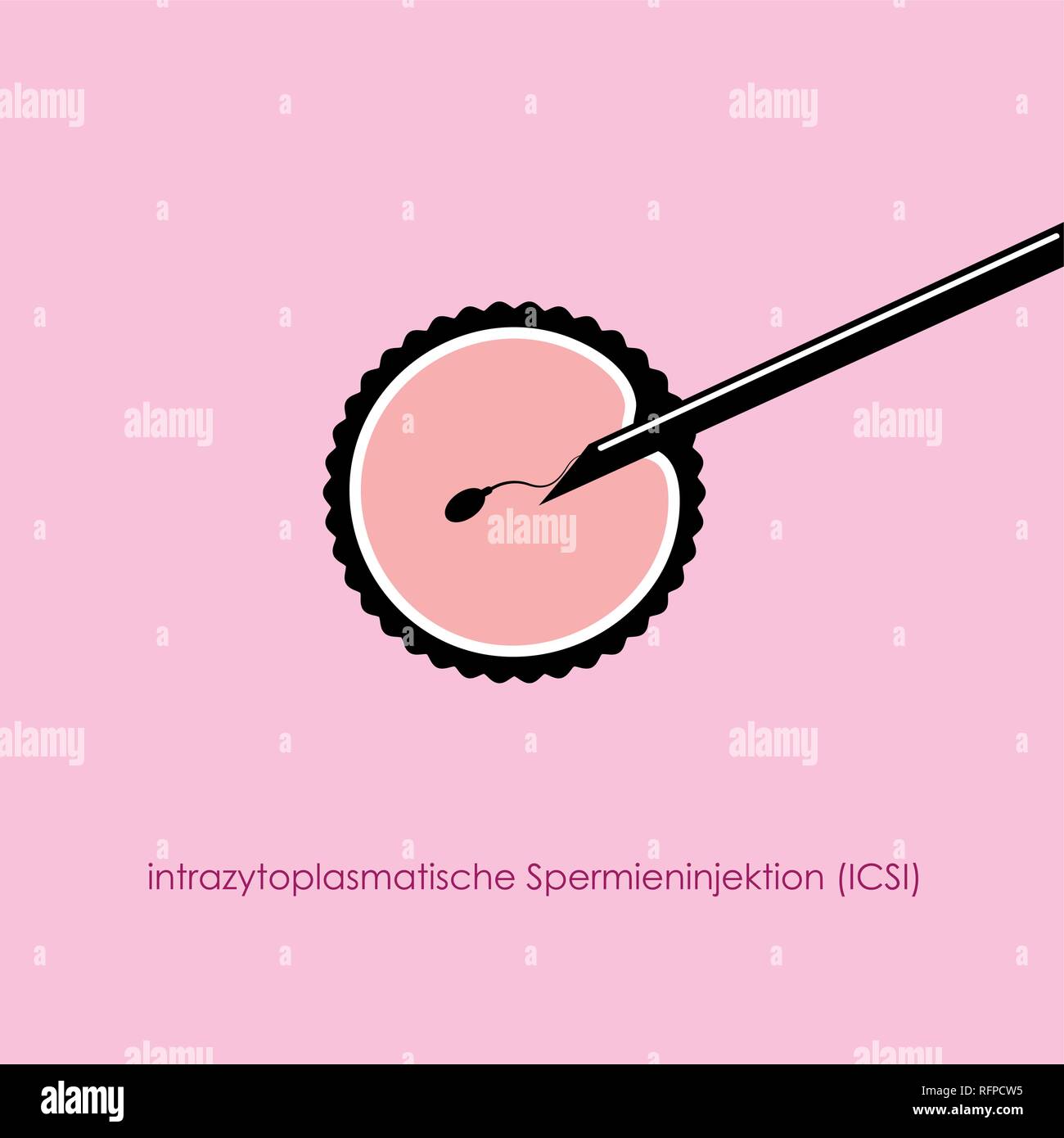 Künstliche Befruchtung ICSI Eizelle Ei mit Nadel und Samenzellen Vektor-illustration EPS 10. Stock Vektor