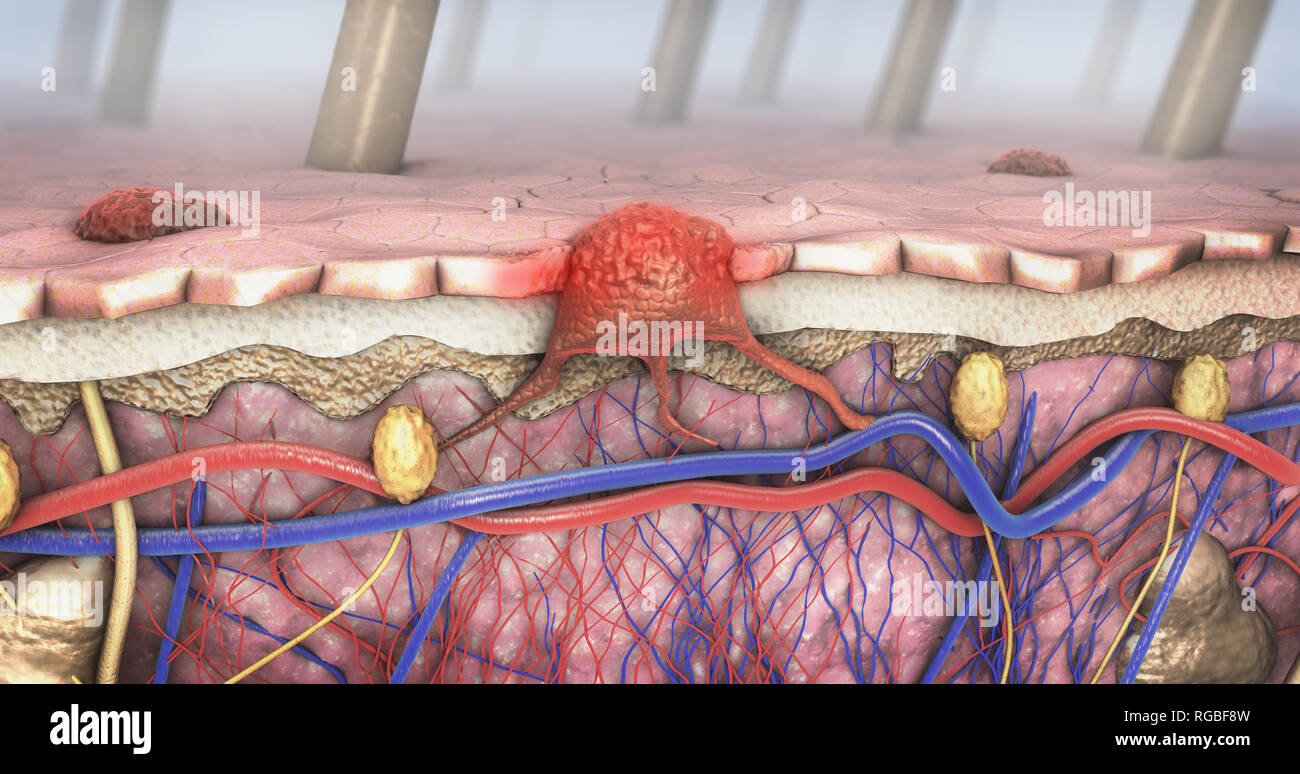 3D-Darstellung der Querschnitt einer kranke Haut mit Melanomen, die in die Blutbahn und lymphatische Trakt Stockfoto