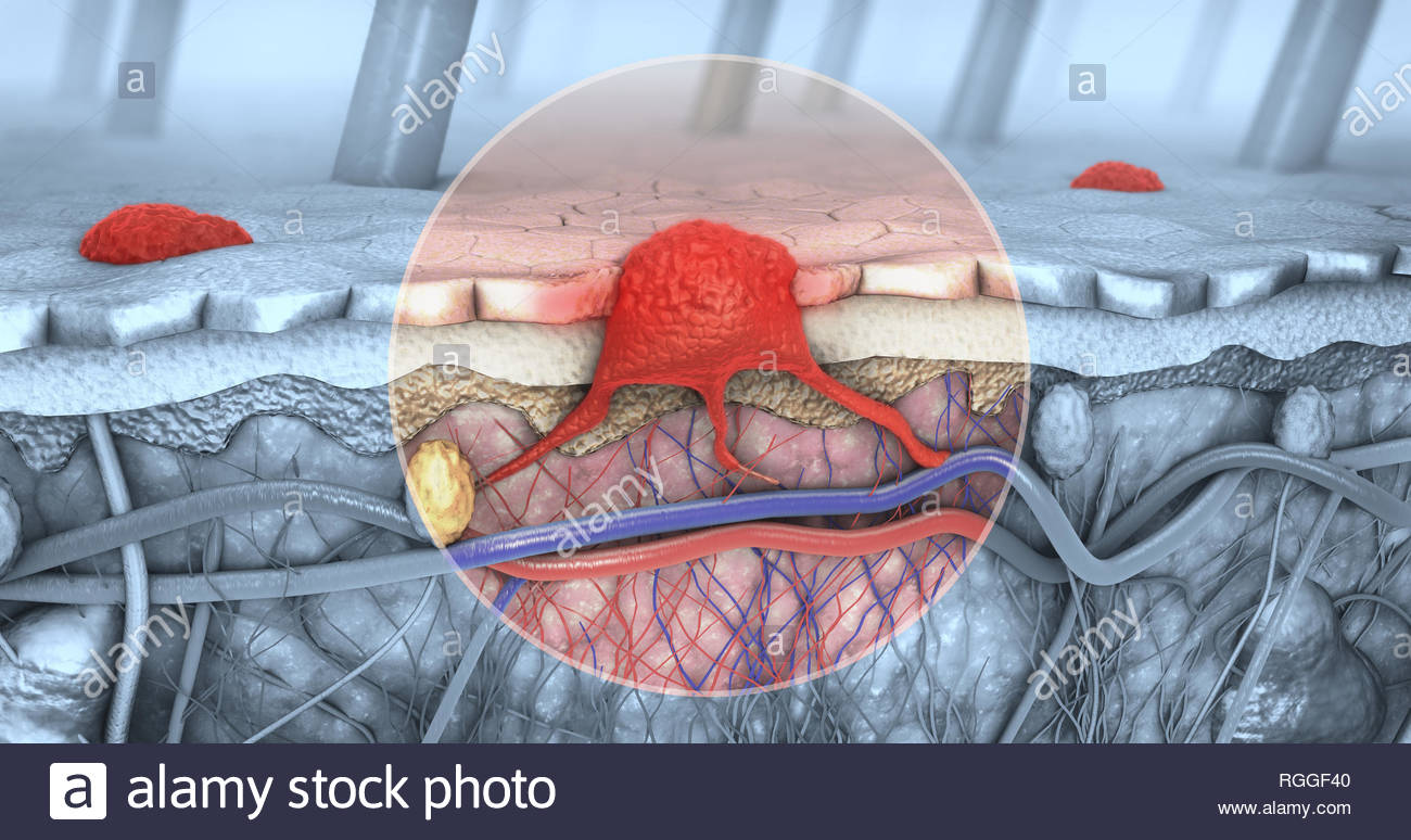 Metastasen Auf Der Haut Bilder www.alamy.de