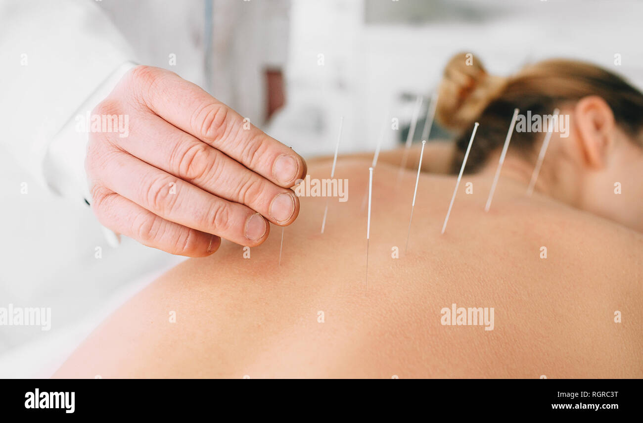 Acupuncturist Einführen einer Nadel in eine weibliche zurück. Patienten mit der traditionellen Chinesischen Behandlung mit Nadeln einen Energiefluss durch spec Wiederherstellen Stockfoto