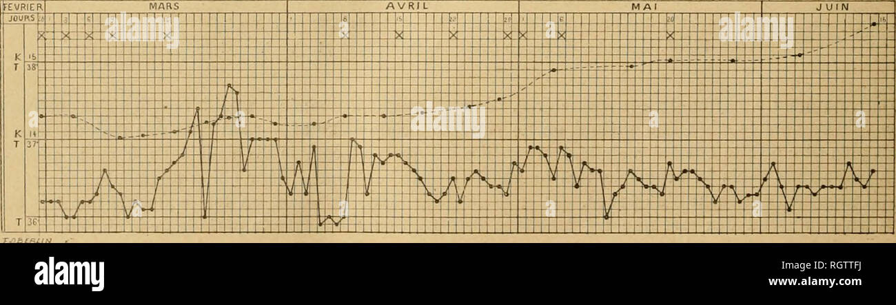 . Bulletin biologique de la France et de la Belgique. Biologie; Natural History. Abb. 0. Fif;. *, S ul 0. - Cùui - ljcs ilcs poids et des lenipL" ratuvcs Anhänger cL Après le traitcnienl. - De température Coui" liegen. - Courbe de poids, X Jours d'injcclion. 111 vingt-deux malades atteints d'ostéo-arthriies tuberculeuses du genou, arthrites de Garde-de-Pied, du coude, Plaketten fongueuses du Thorax, Spina ventosa, adénites tuberculeuses cervicales, ont été Verfasst von au traitement. Tous ont été notablement régularité; leur poids augmente progressivement; ils vivent Enfin, depuis un mois de la vie Kommune des Stockfoto