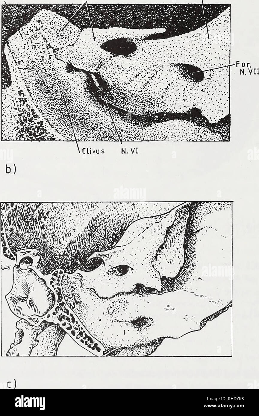 . Bonner zoologische Beiträge: Herausgeber: Zoologisches Forschungsinstitut und Museum Alexander Koenig, Bonn. Biologie; Zoologie. Durchtriti-d. N. VI Clivus Für. Jugulare Q) Dors. sellae Platten d. Trig, bröcke Crist, Petr.. Abb. 5: Übersicht über drei verschiedene Varianten von Trigeminusbrücken beim Menschen (Objekte der Sammlung des Anatomischen Institute Köln), a) und b) Seitliche unvollständige Brücken, sterben / medial in plattenartige Auflagen im Bereich des Dorsum sellae übergehen und zugleich auch den N. abducens abdecken, c) Medial unvollständige Brücke mit seitlichen massiver-an-der Wurzel Stockfoto