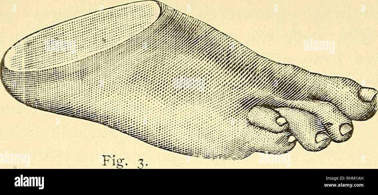 . Biologische Studien. Biologie. 134. die Massen. War an den Händen schon bemerkt worden war, zeigte sich auch an den Füssen. Der linke Getue Krieg hinter dem rechten in der Ent-wicklung von ein wenig "zurückgeblieben. Namentlich erreich-ten seine etwas schmächtigeren Zehen nur knapp das Masse, das jene Panzeraufklärungstruppe besassen. Auch befanden sich in einer anhaltend dieselben krampfigen Stellung, leichten Flexion, und waren deshalb krummer als des rechten Fusses sterben. Sie befanden sich auch offenbar in einem erhöhten Reizzustande denen der rechten Seite gegenüber. SonstwarenHände^^^ gs-se und Füsse gut ge-Bild Stockfoto