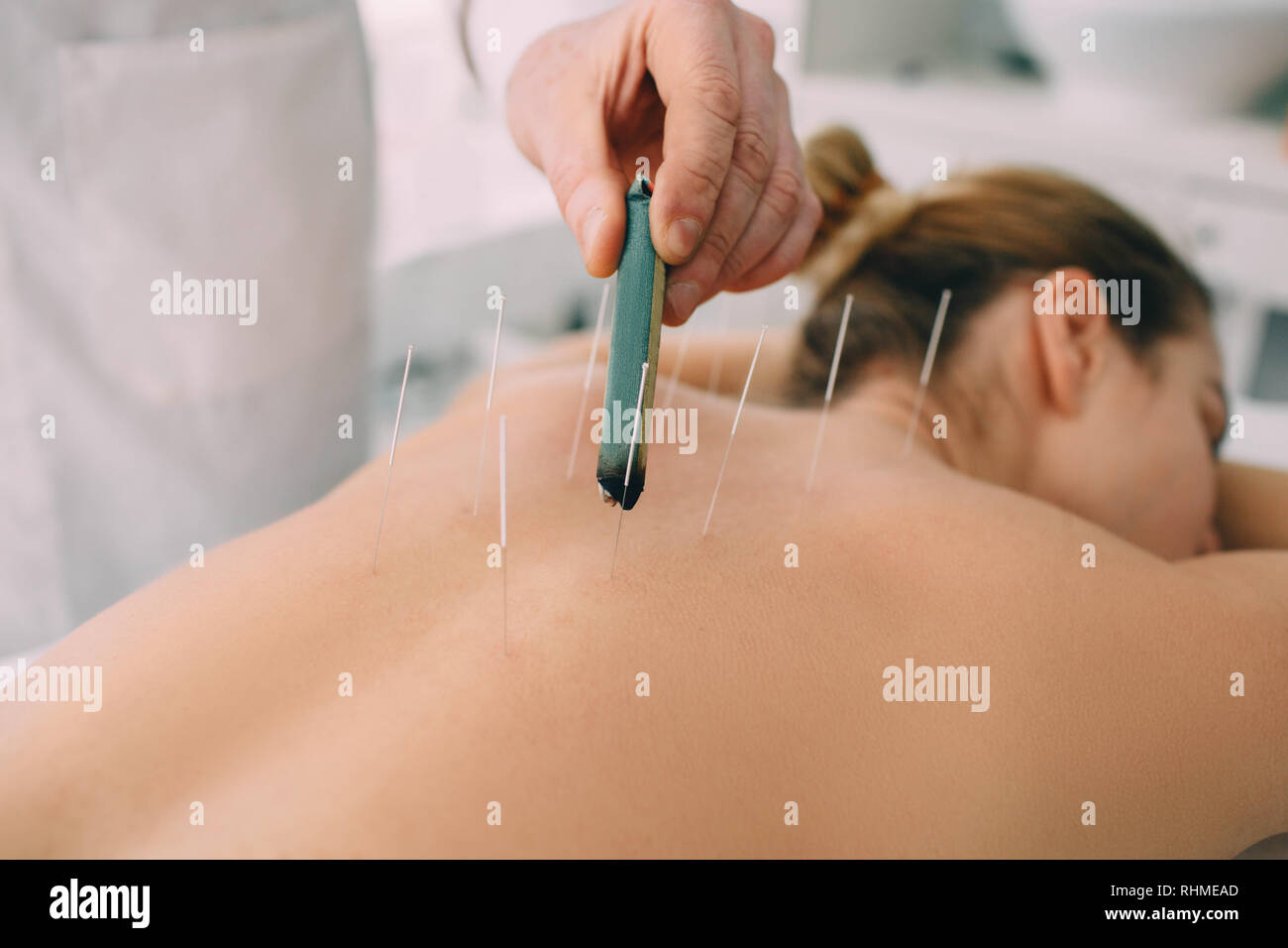 Client in Akupunktur Behandlung auf ihr zurück Stockfoto