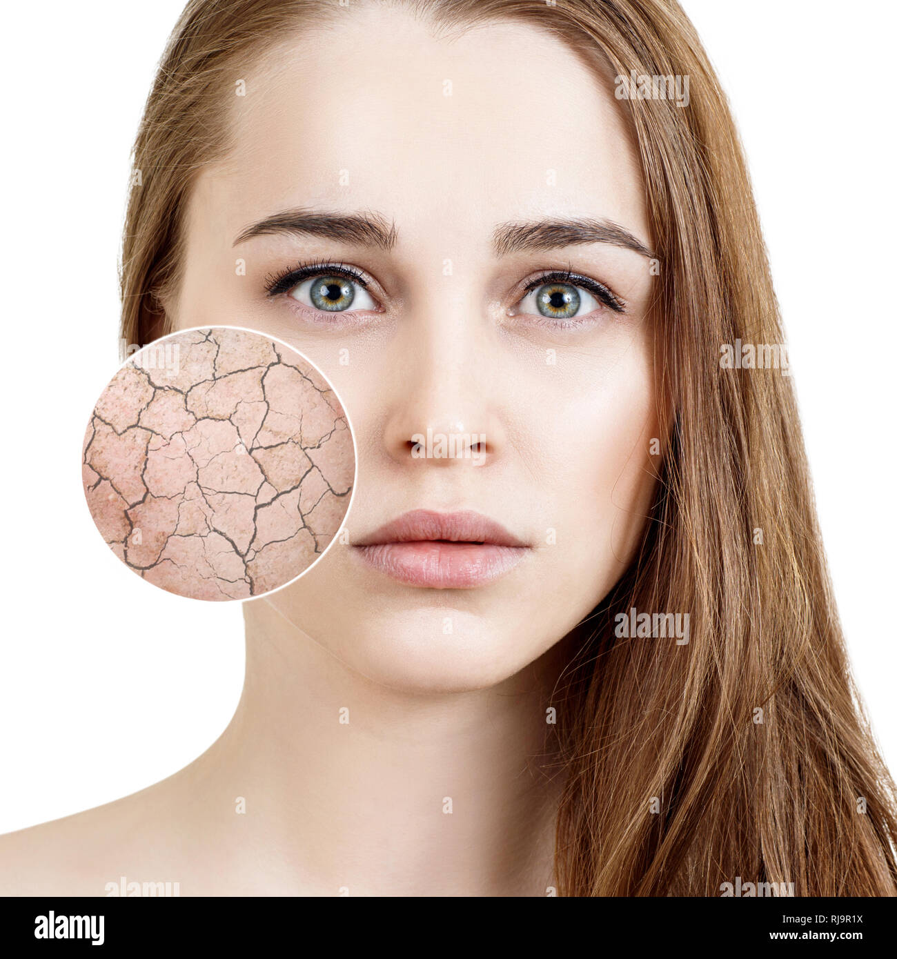 Zoom Kreis zeigt trockene Gesichtshaut vor befeuchten. Stockfoto