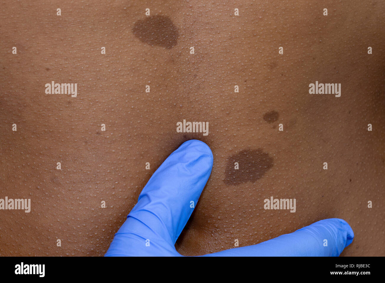 Arzt Hautarzt untersucht Junge afrikanische Frau mit maulwürfe auf ihrem Bauch Muttermal, Kontrolle gutartige Muttermale. Neurofibromatose Stockfoto