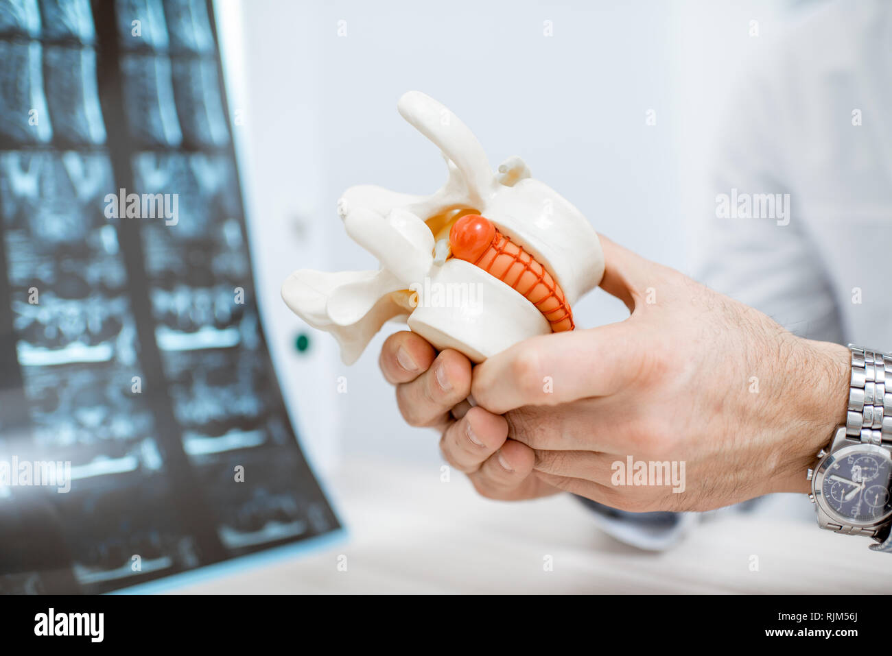 Nahaufnahme der Therapeut Holding anatomische Modell der Wirbelkörper mit Bandscheiben Bandscheibenvorfall Stockfoto
