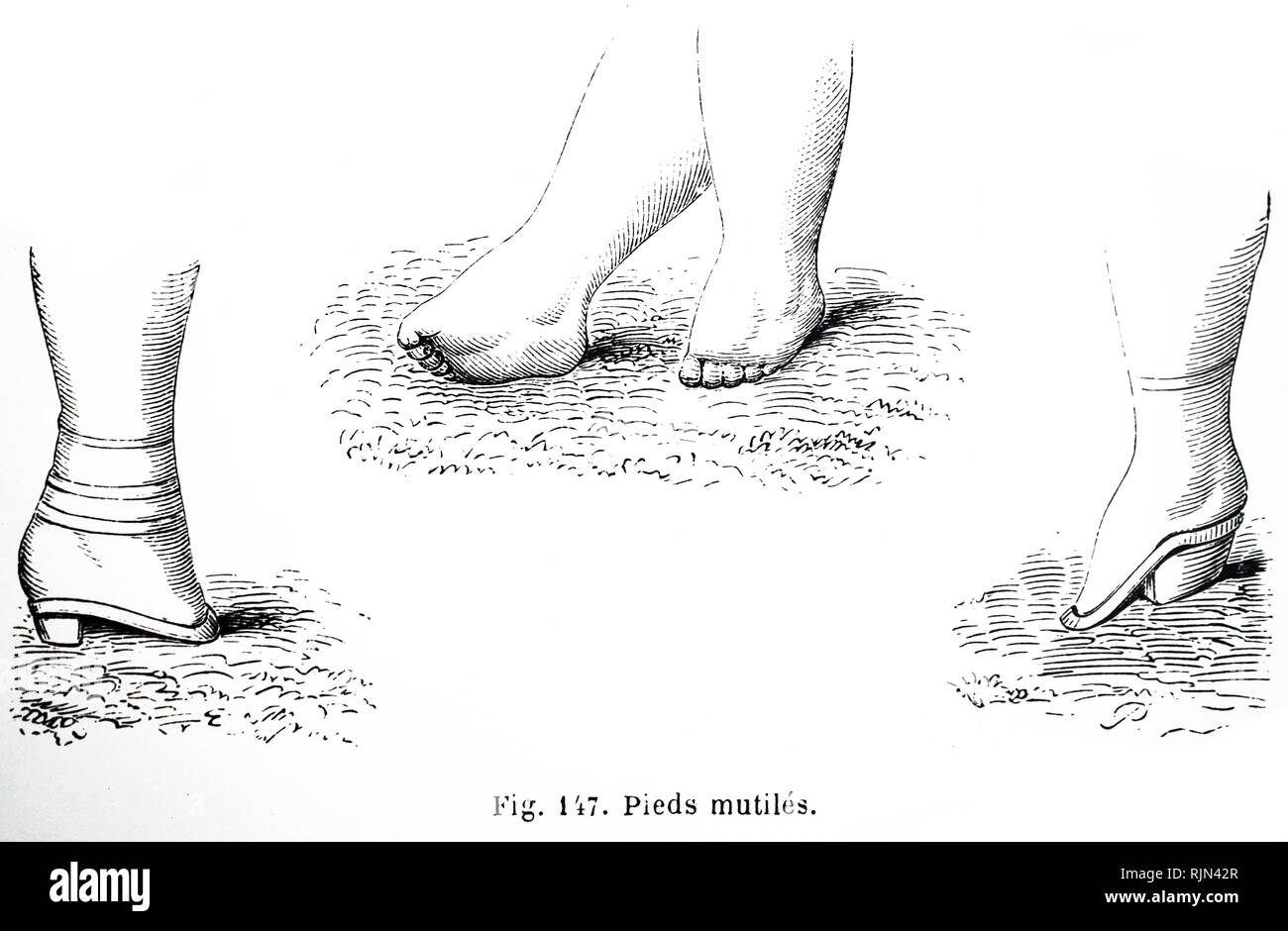Abbildung: Folgen der Fuß verbindlich im 19. Jahrhundert, China. Stockfoto