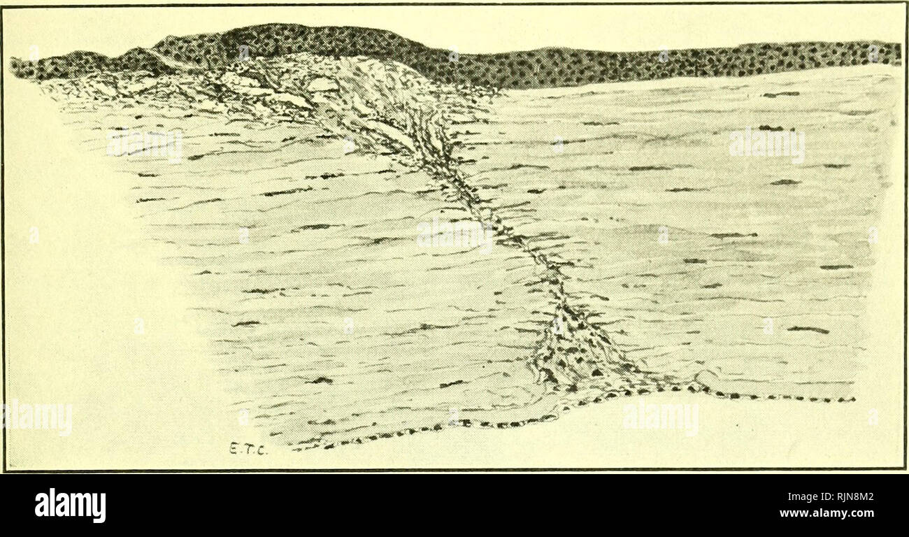 . Pathologie und Bakteriologie [elektronische Ressource]. Augenheilkunde; Auge; Auge; Bakteriologie; Augenheilkunde; Auge; Bakteriologie; Auge. Wunden DER HORNHAUT 379 durch das Fasergewebe externen Schicht des Auges, als mit einem Graefe Messer (Bild gemacht. 206). Die Schräglage des Einschnitts erleichtert die frühzeitige Schließung. Die Gefahr, einen Schnitt für eine iridectomy so peripher, da durch die ligamentum pectinatum, Prolaps des Ziliarkörpers auftreten können. Wenn Sie den vorderen Teil der. Abb. 208.- Heilung perforieren Wunde am Limbus mit einer Klappe der Bindehaut. Subepithelial va Stockfoto