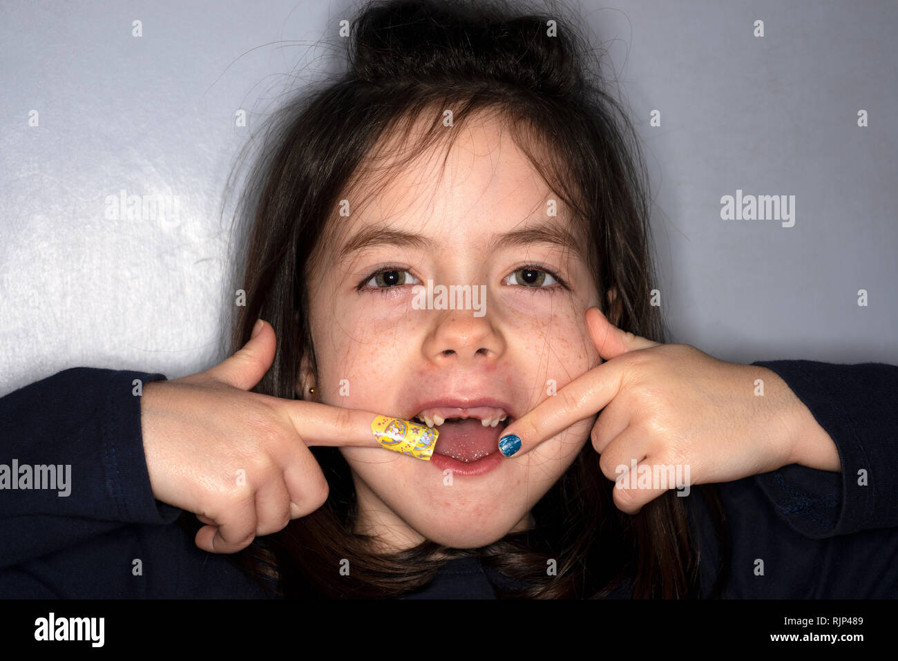 6-Jähriges Mädchen mit fehlenden vorderen Zähne Stockfoto