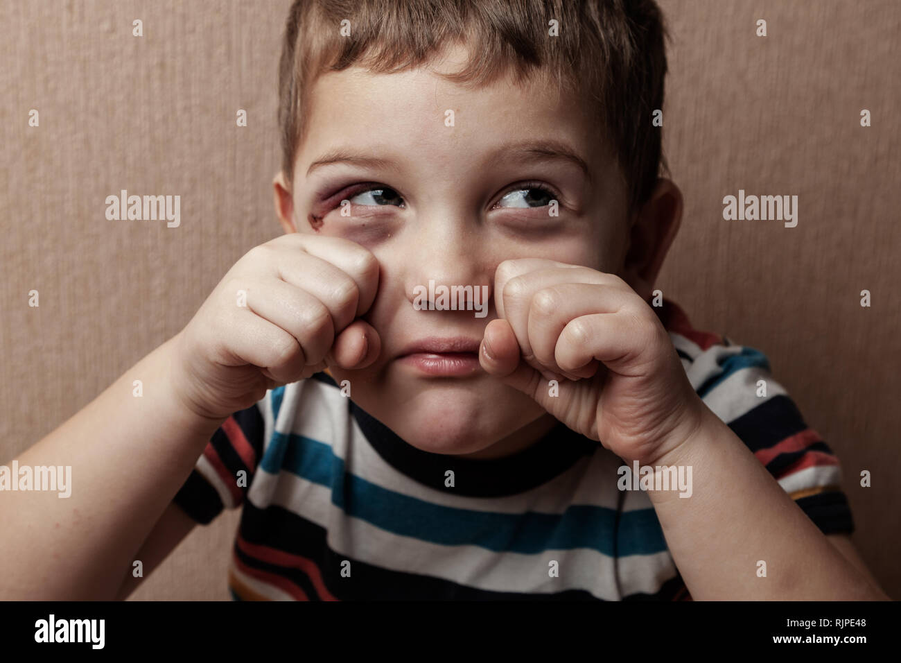 Gewalt in der Familie. Kindesmissbrauch. Ein schreiendes Kind mit blauen Flecken unter seinen Augen Stockfoto