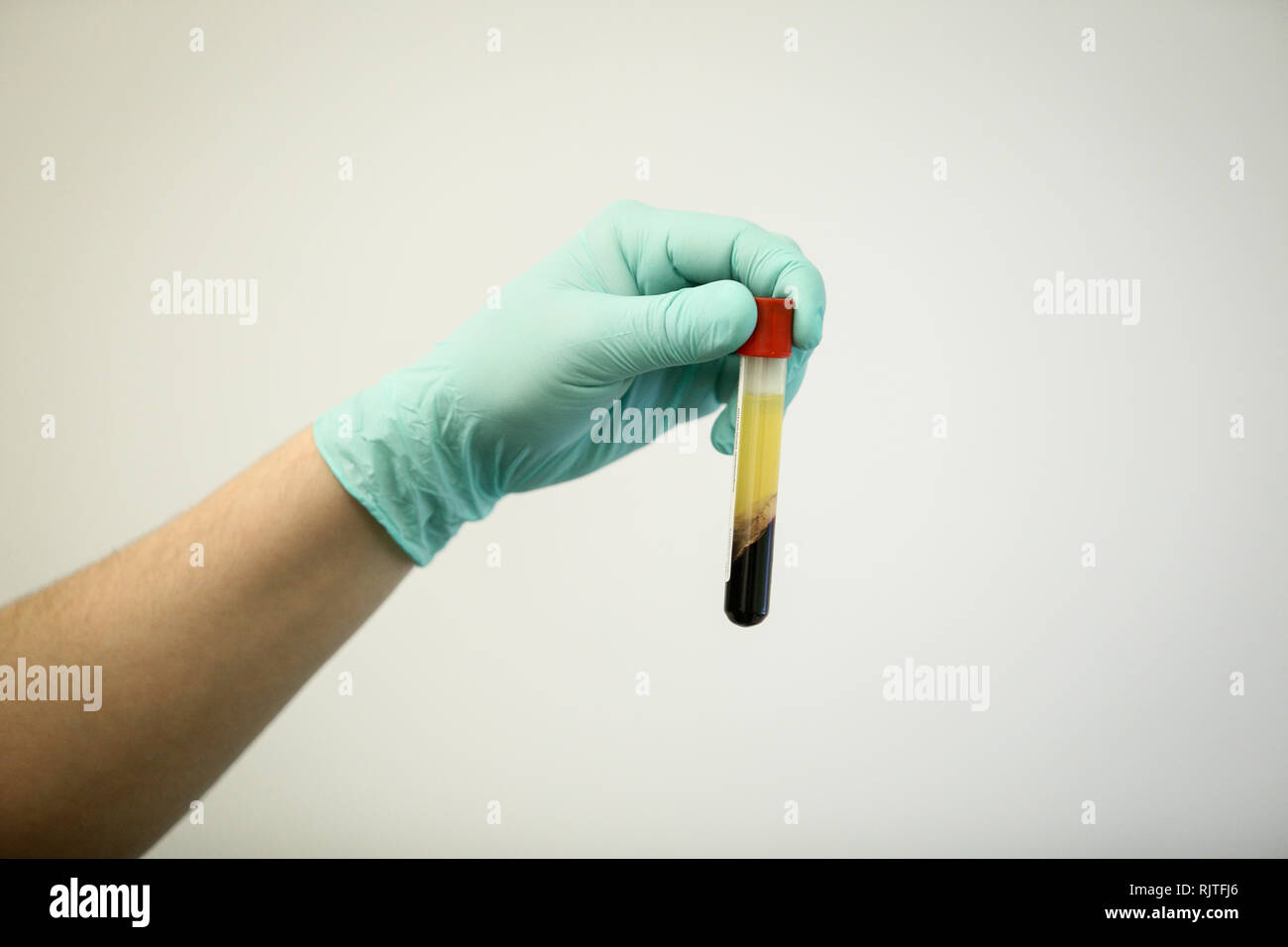 Details mit der Hand eines Arztes, strapazierfähiges Gummi OP-Handschuh und hält eine Durchstechflasche mit Blutplasma extrahiert aus Blut durch Zentrifugation Stockfoto