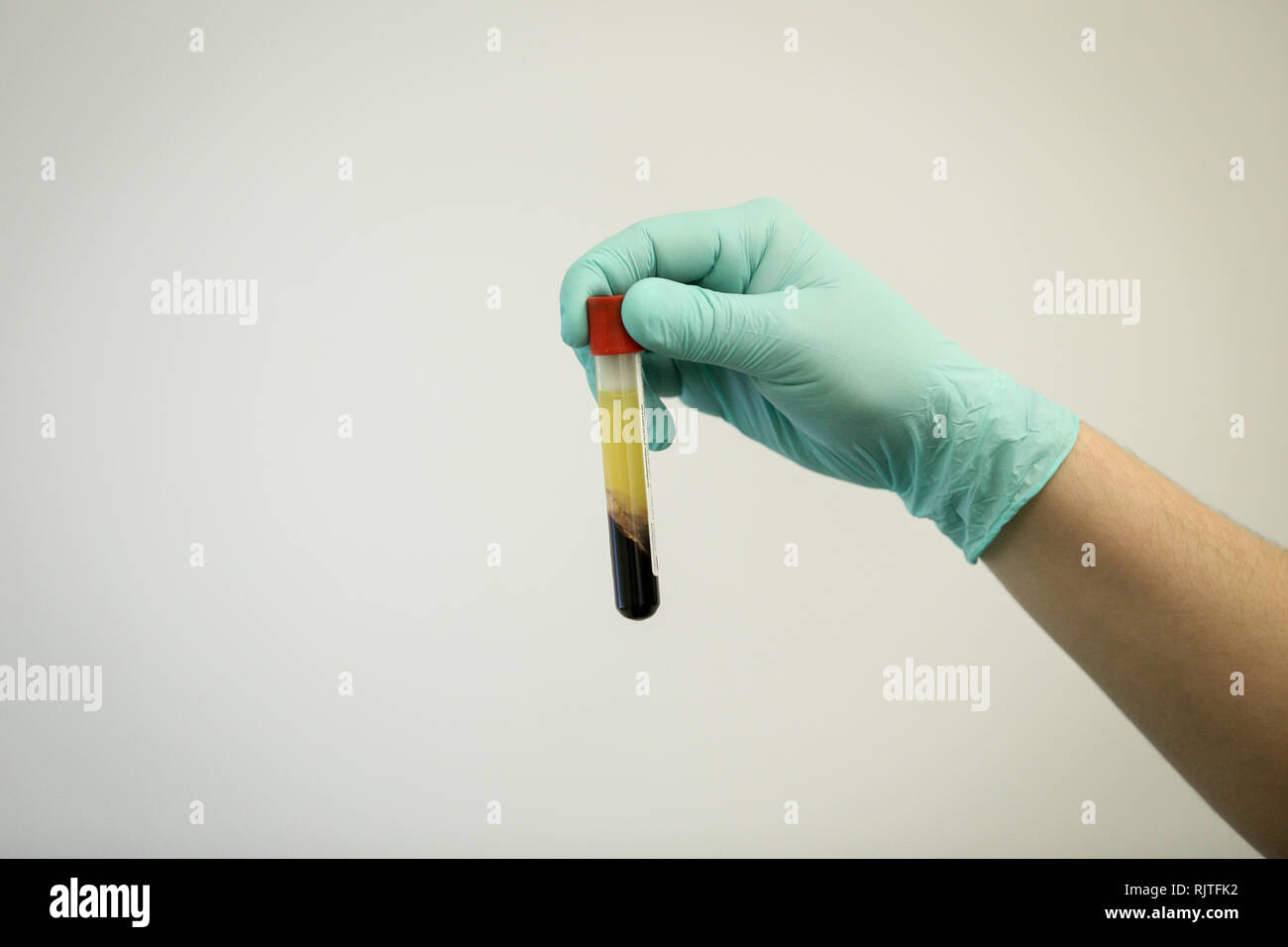 Details mit der Hand eines Arztes, strapazierfähiges Gummi OP-Handschuh und hält eine Durchstechflasche mit Blutplasma extrahiert aus Blut durch Zentrifugation Stockfoto