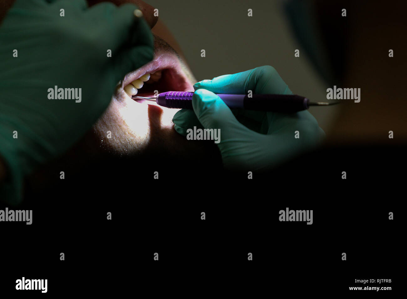 Details mit den Händen einer Frau, Zahnarzt, mit OP-Handschuhe, arbeiten mit speziellen Werkzeugen im Mund eines Patienten Stockfoto