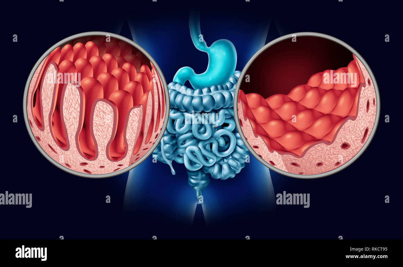 Zöliakie oder Zöliakie wie ein Darm Anatomie medizinisches Konzept mit normalen Darmzotten und beschädigte Dünndarm Futter als eine autoimmune Störung. Stockfoto