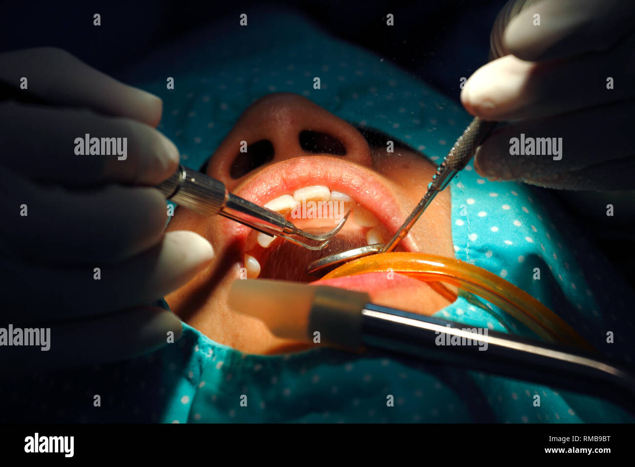 Closeup zahnmedizinische tiefe Reinigung durch Skalierung Plakette von Patienten Zähne Stockfoto